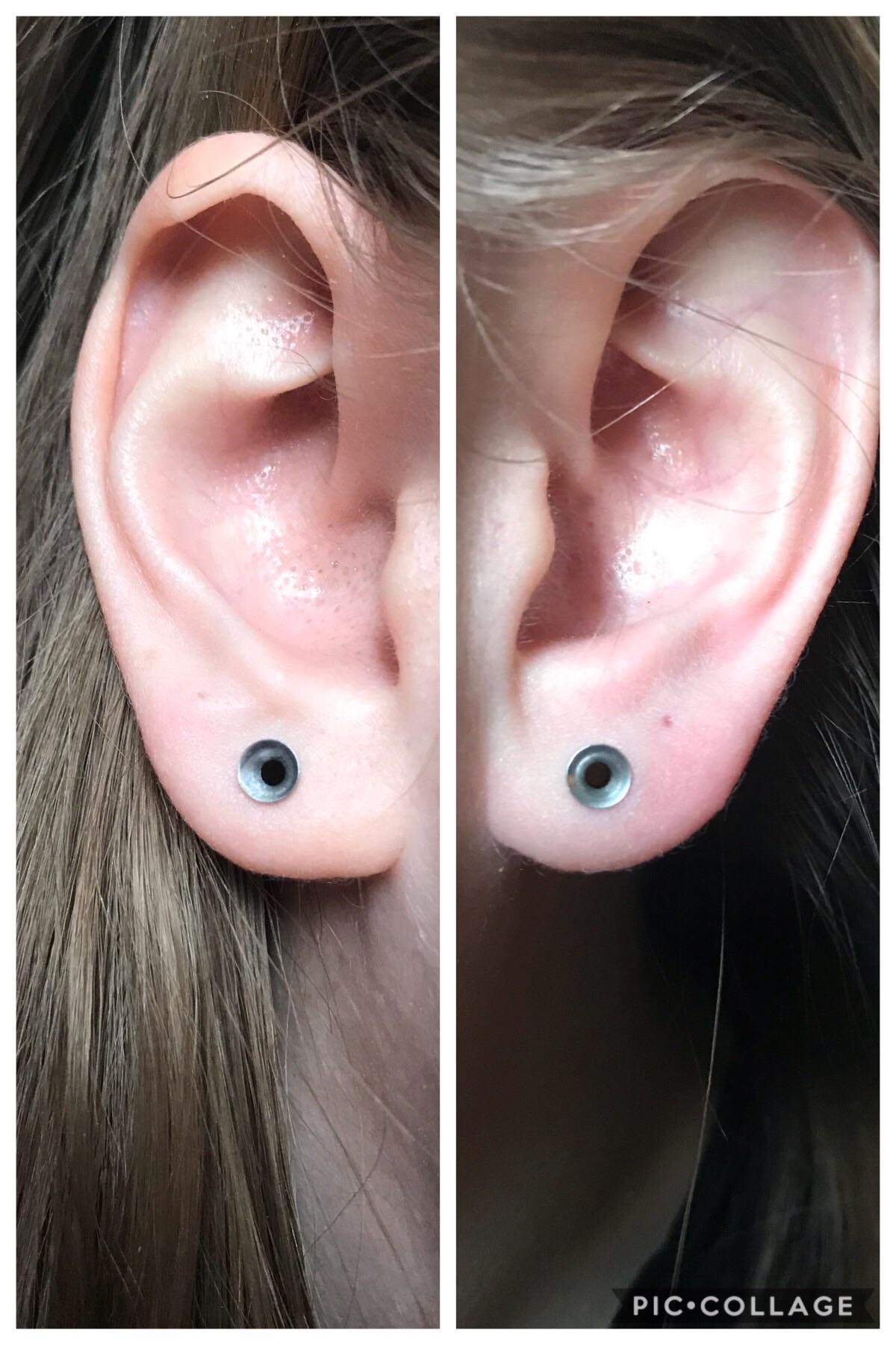 Thinking of getting my ears scalpelled because they are uneven. I