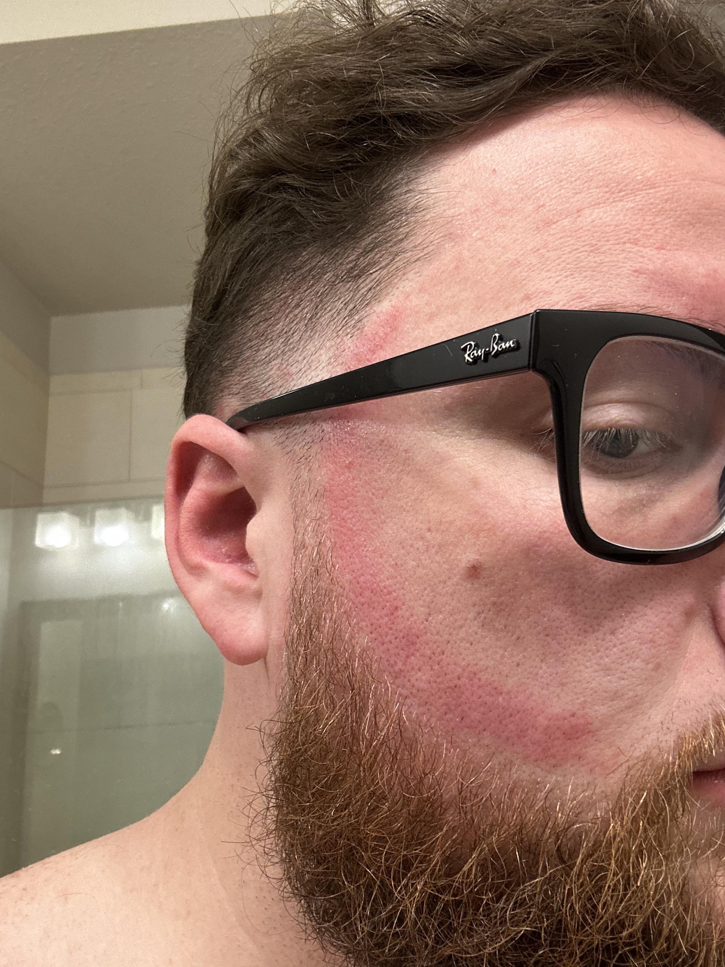 Anyone know what causes this irritation after using a straight razor