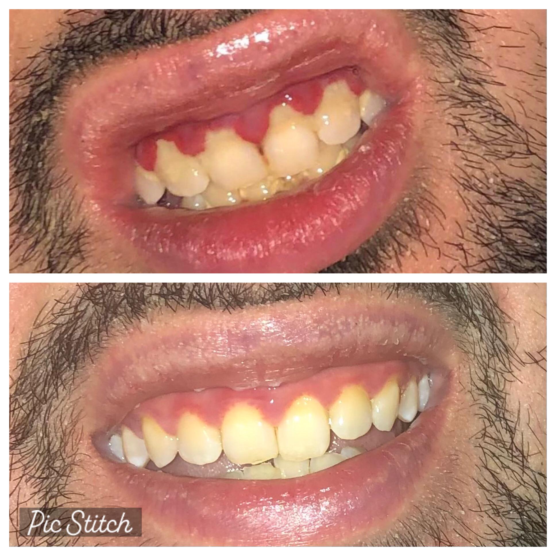SRP before/after. Advice? r/askdentists