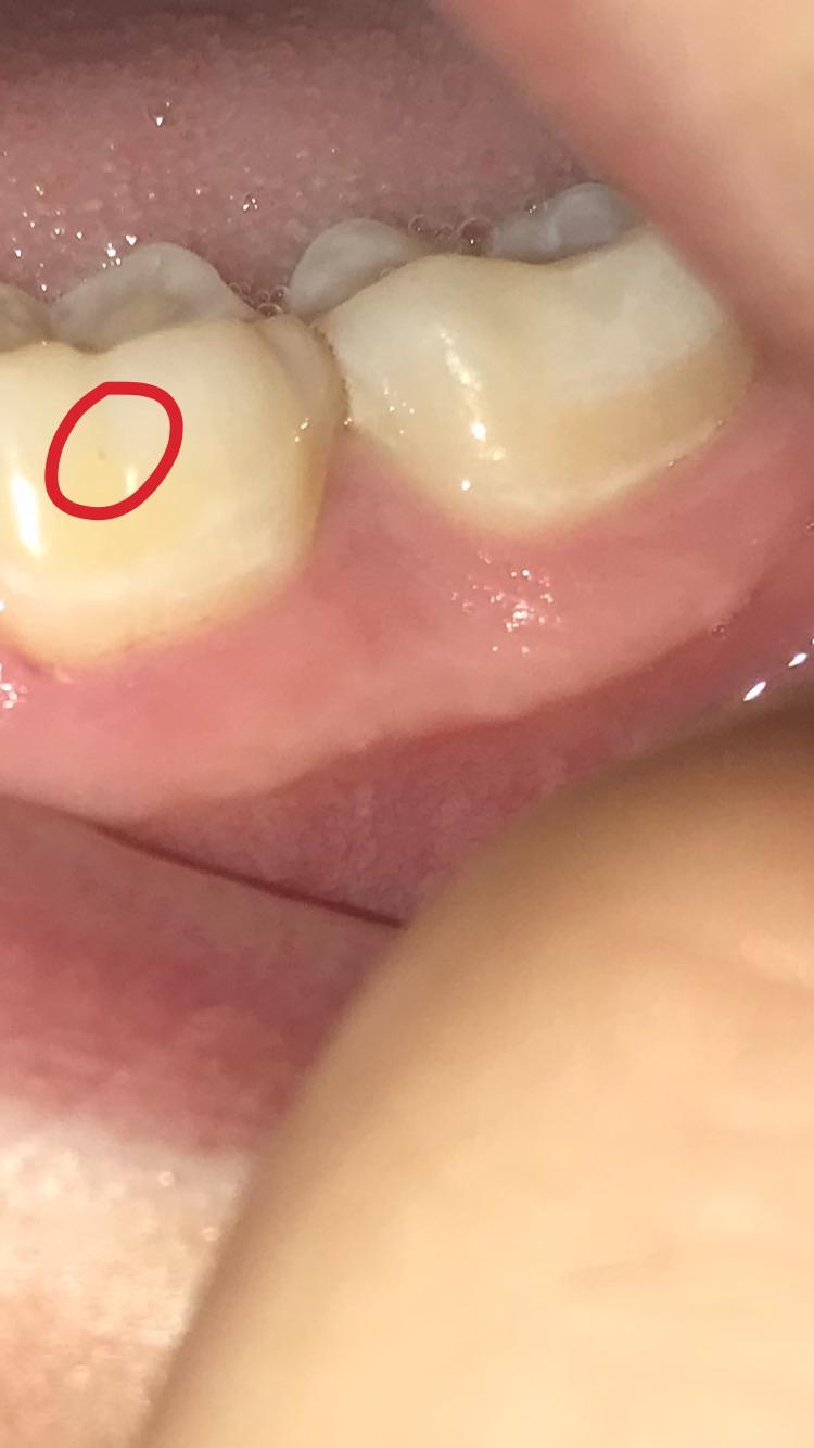 How To Know If You Have A Cavity Reddit Let It Grow A Trunk Cavity