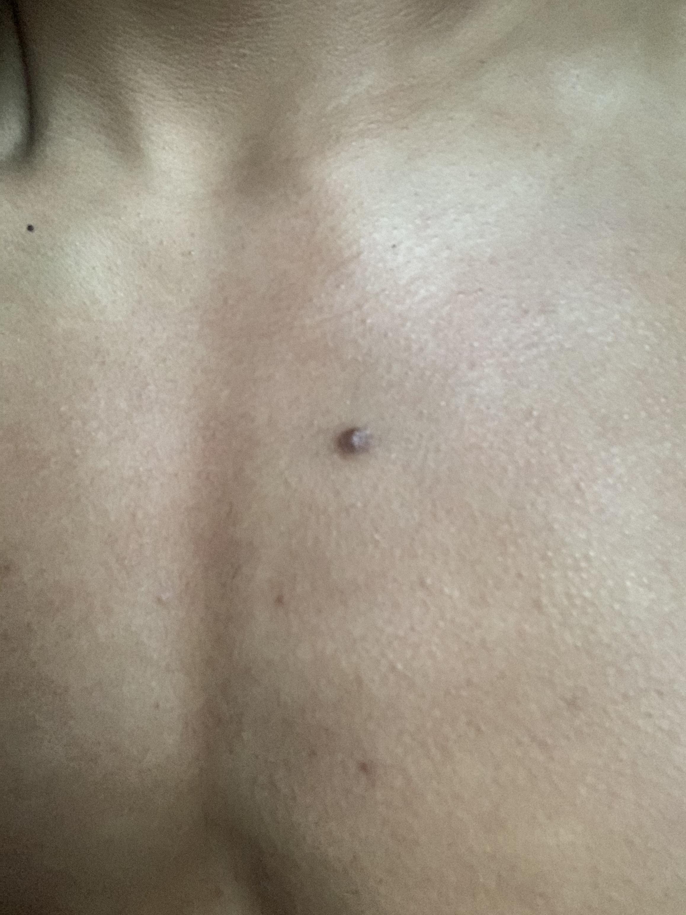 Dermatologists of Reddit, can you identify what this “thing” is on my