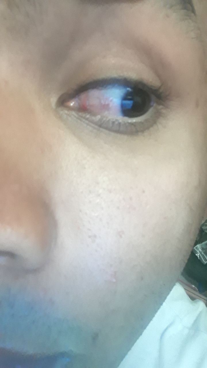 One side of the eye is red but not everything What could it be? r