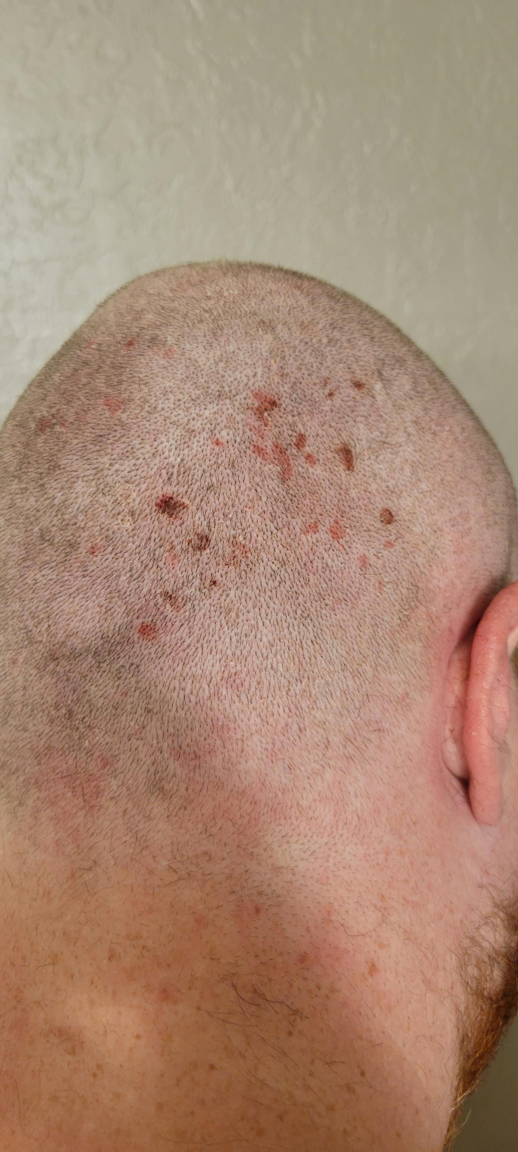 My partner gets these sores on the back of his head. We decided to