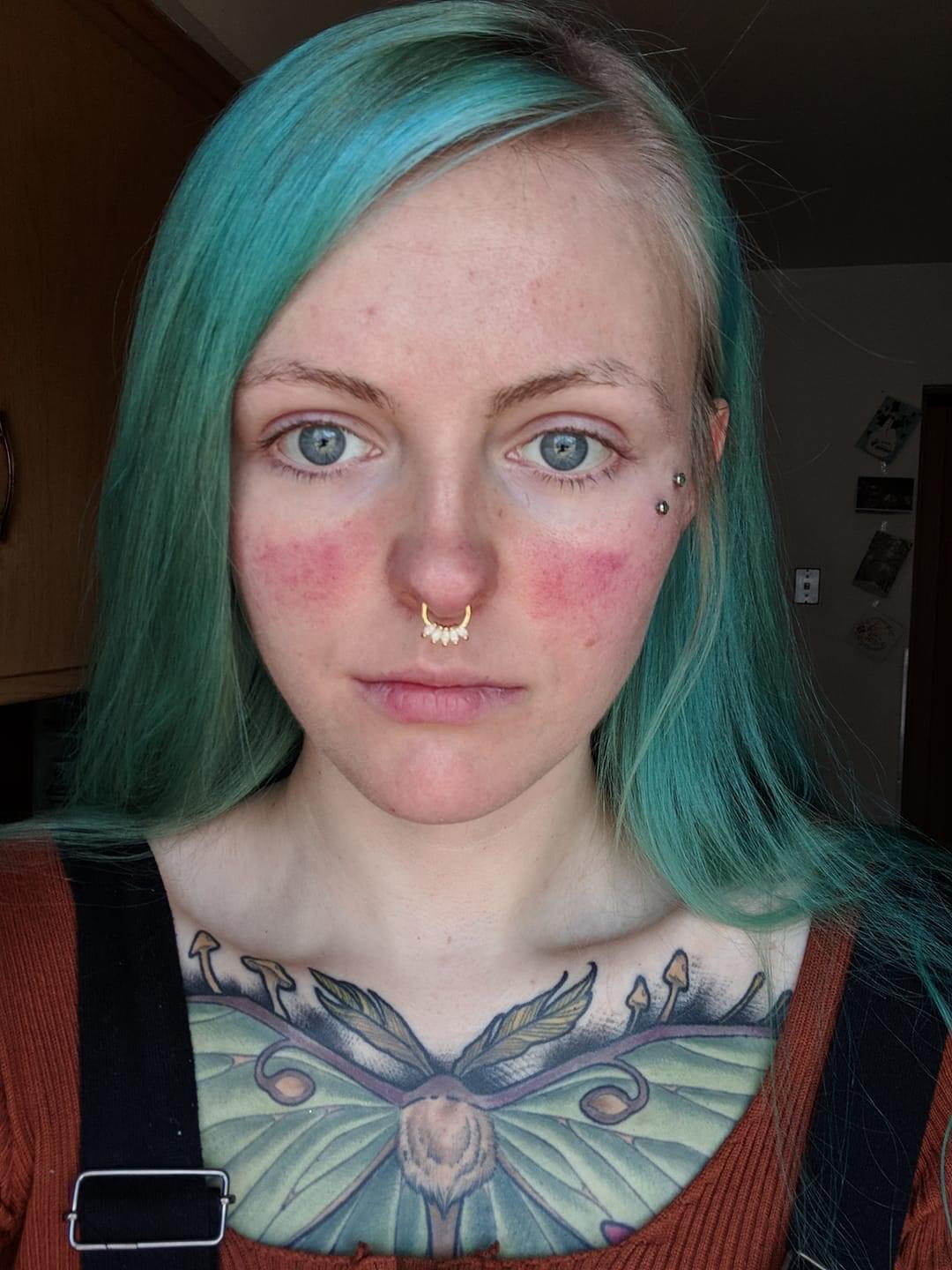 erythematotelangiectatic rosacea and pulsed dye laser (ert & pdl) r