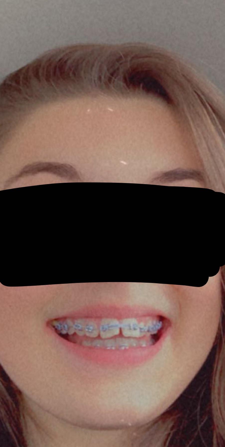 Got my braces on earlier today, I’m in severe pain r/braces