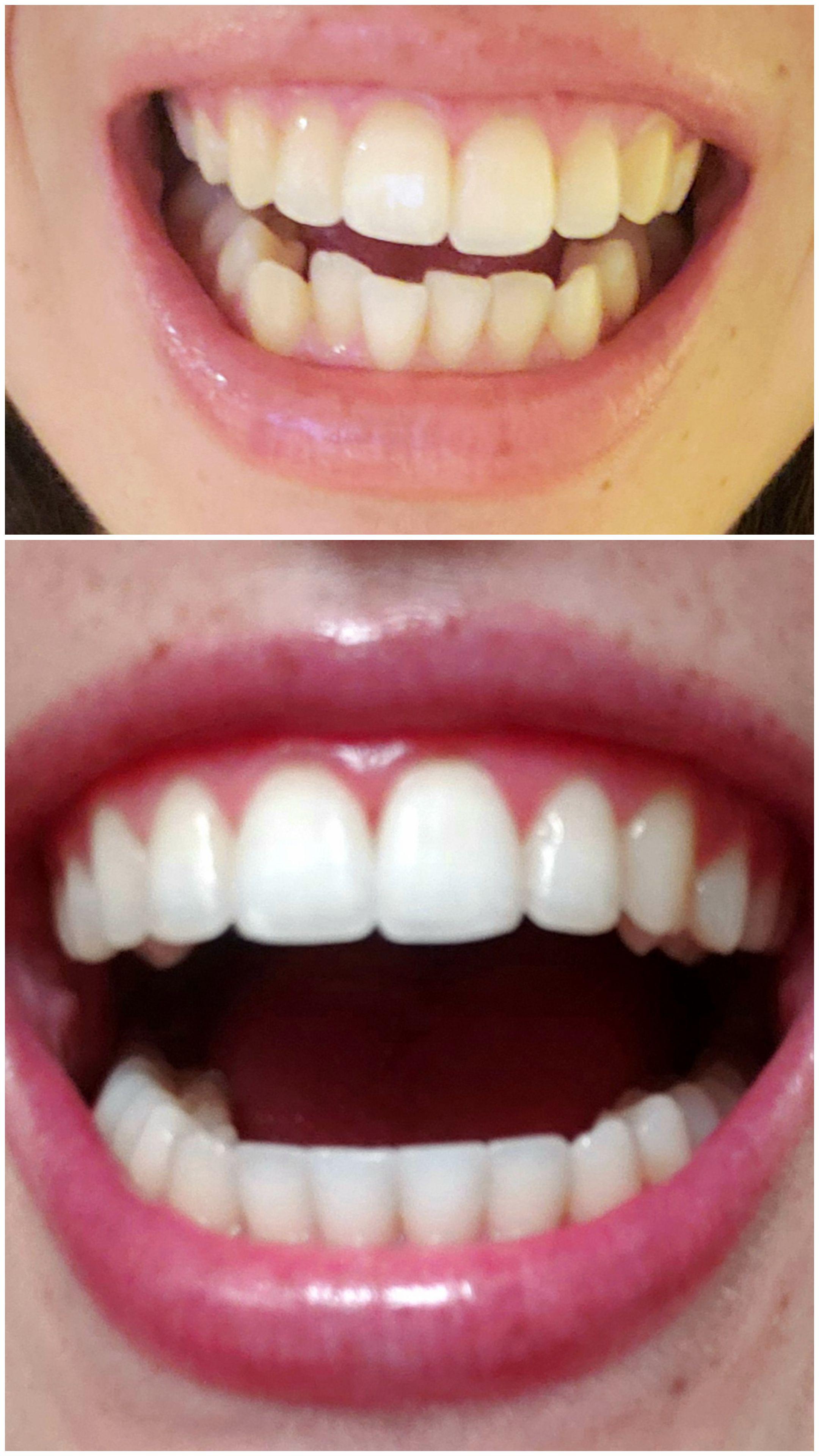 A set of 26 of tray, 8 trays left now. Most probably there will be