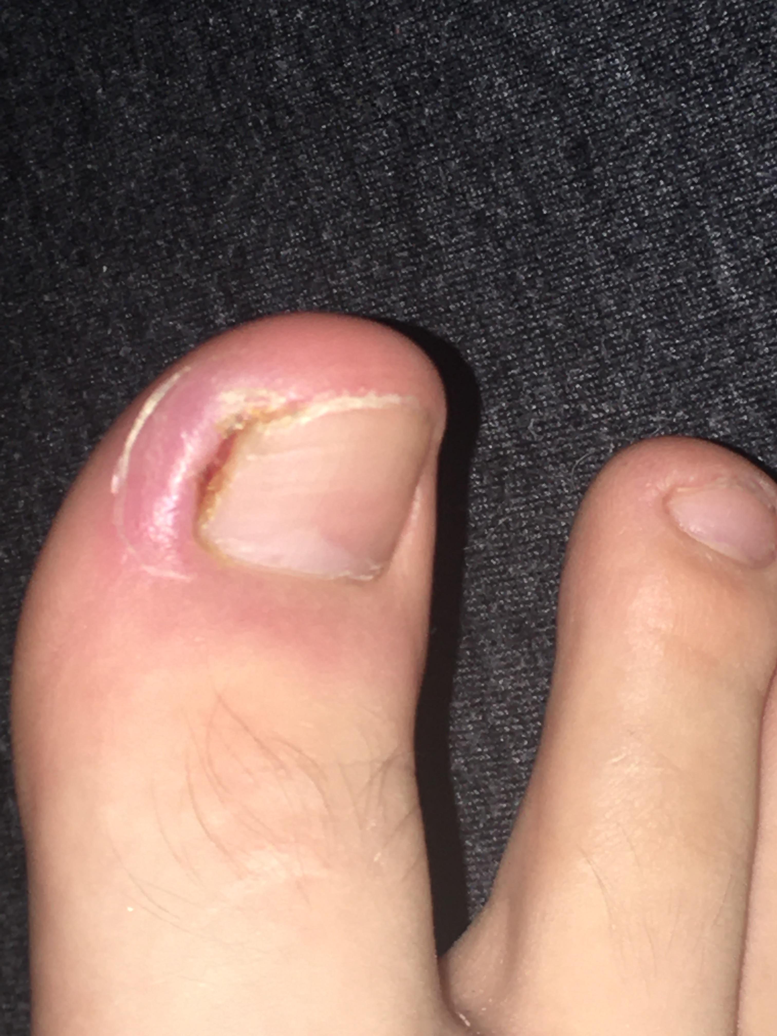 do any doctors know whats happening to my toe? it was bleeding for the