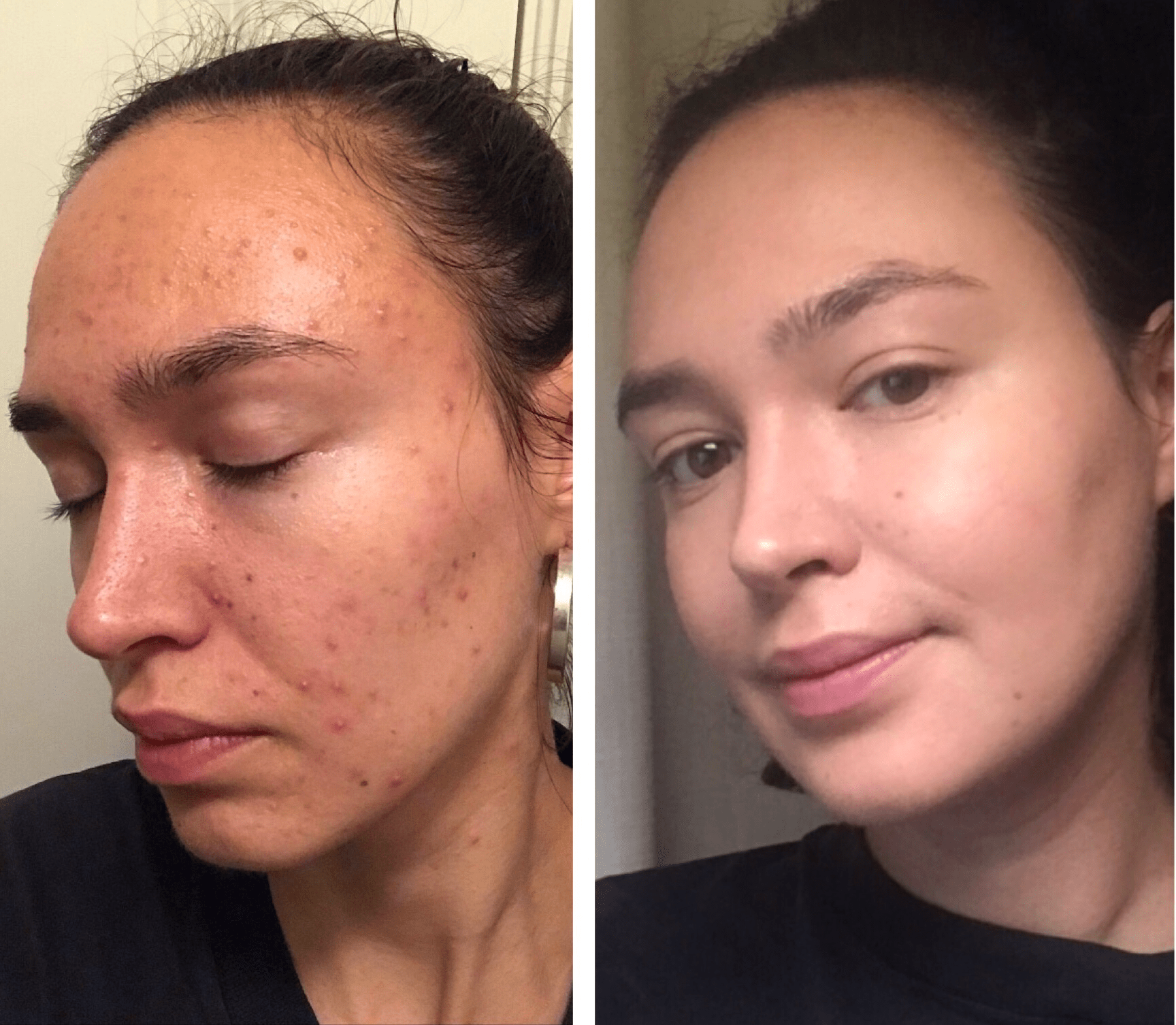 [Before&After] [B&A] [Selfie] [Acne] My skincare journey — one year