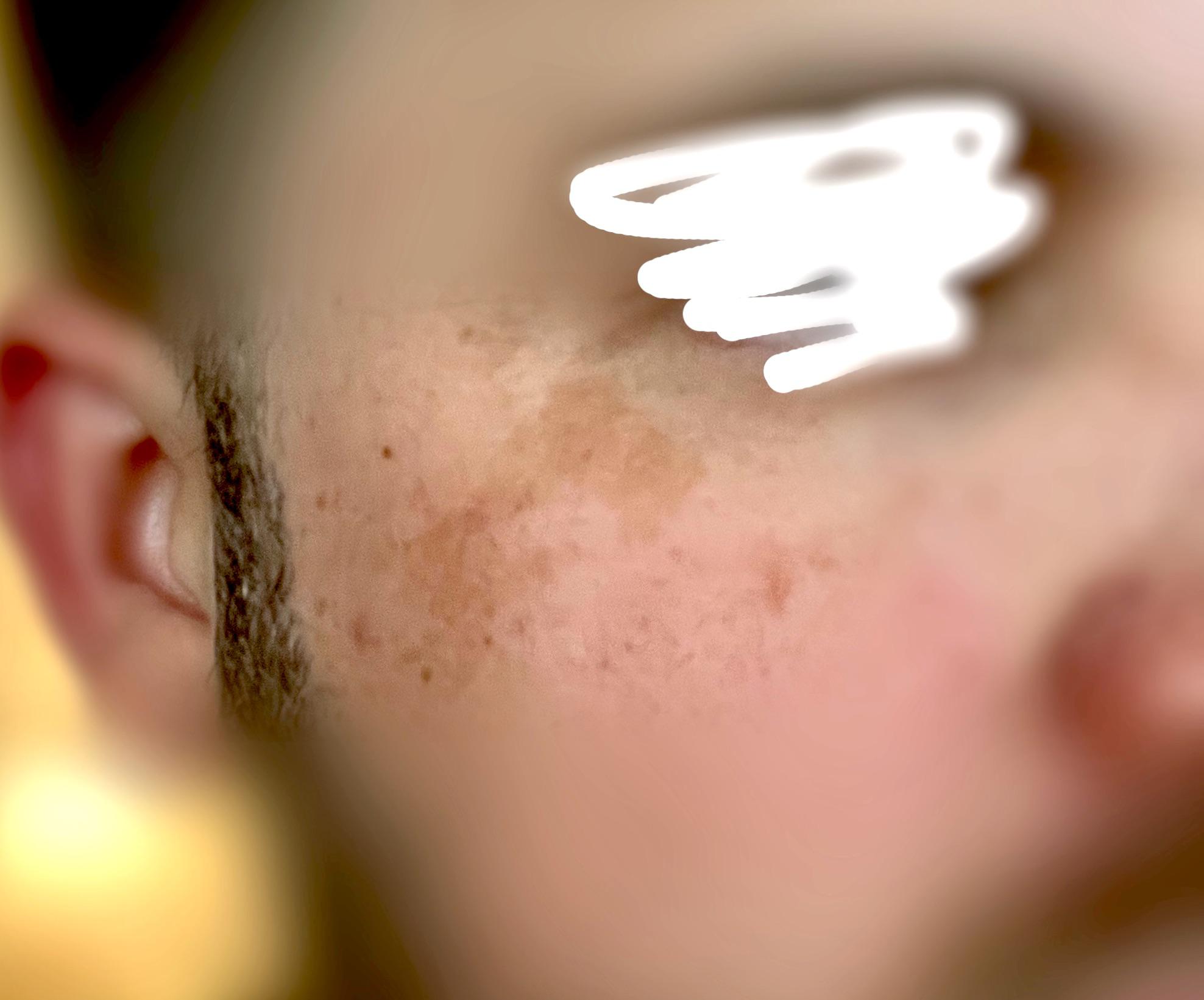 [product request] Dark sun spots on face. What are my options? r