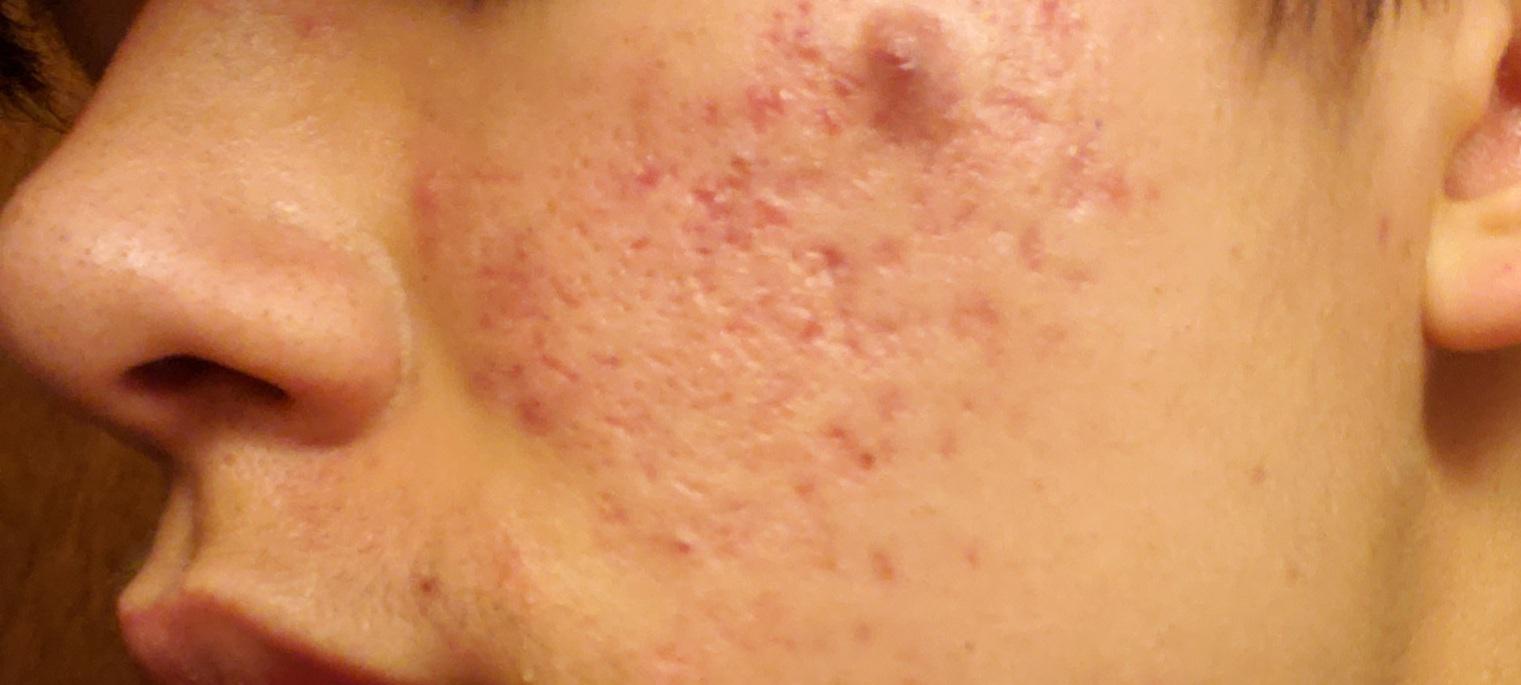 [Skin Concerns] Any ideas on getting rid of this large purple pimple