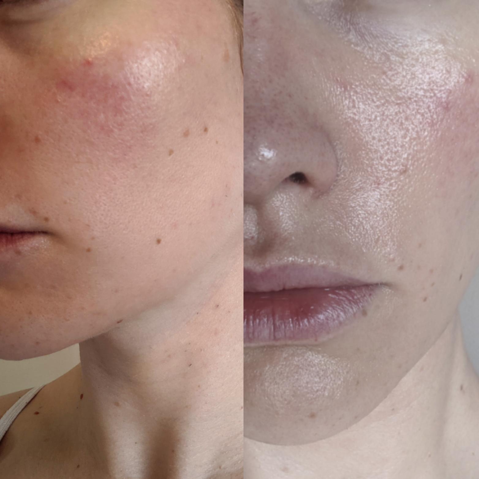 [Skin Concerns] Help! Is this rosacea? How to fix redness, texture and