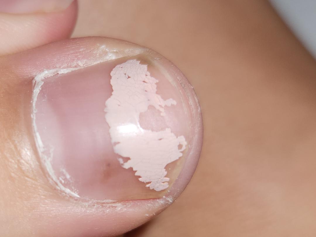 dark spot under nail r/DermatologyQuestions