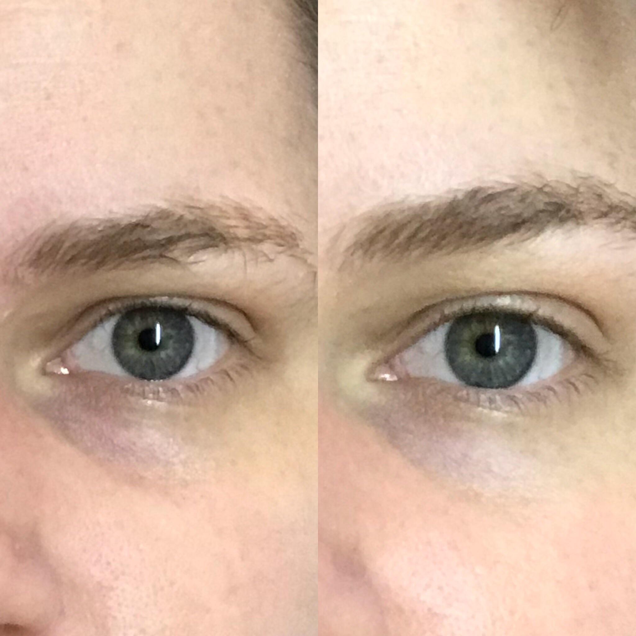 Caffeine solution 5 by The Ordinary results! SkincareAddicts