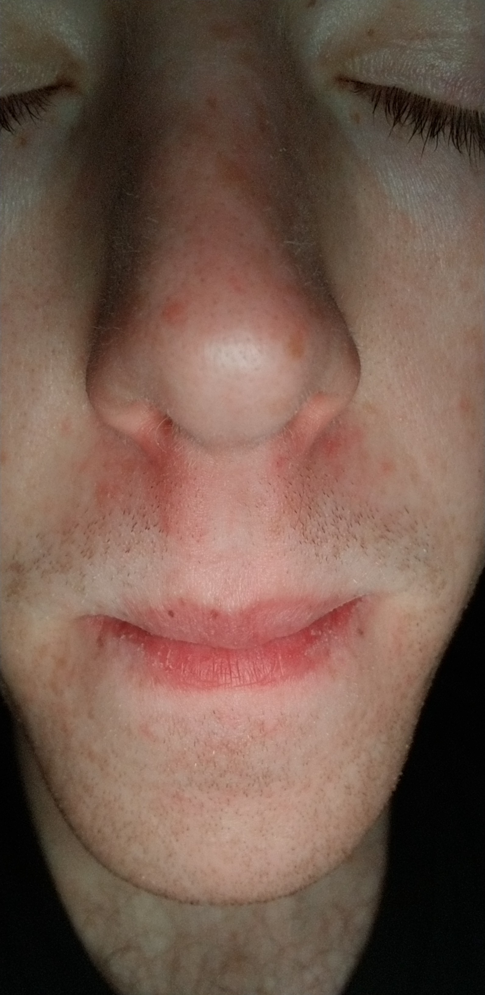 [Skin Concerns] Redness around nose/mouth. r/SkincareAddiction