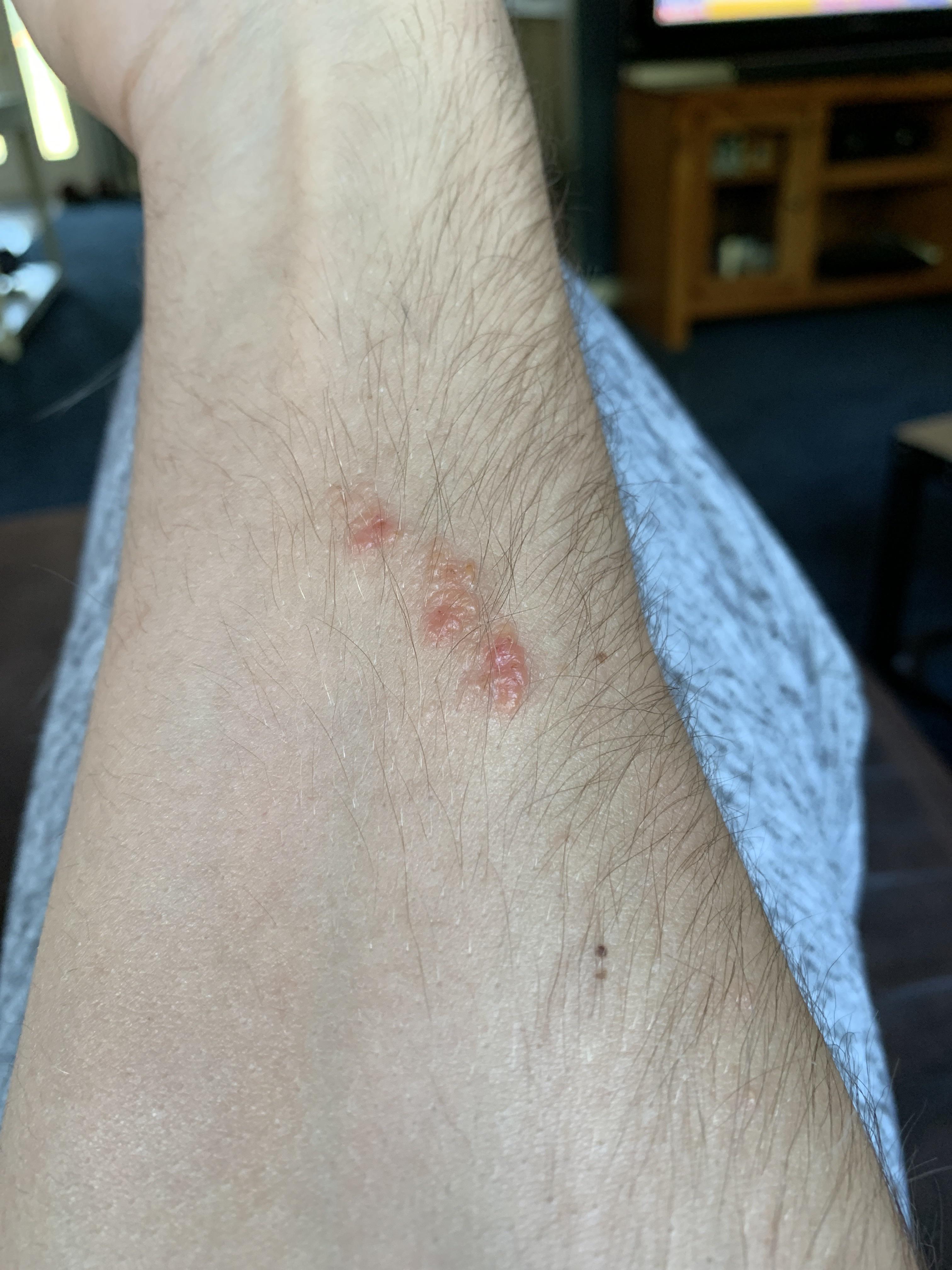 Are these bumps on my forearm poison ivy? r/DermatologyQuestions