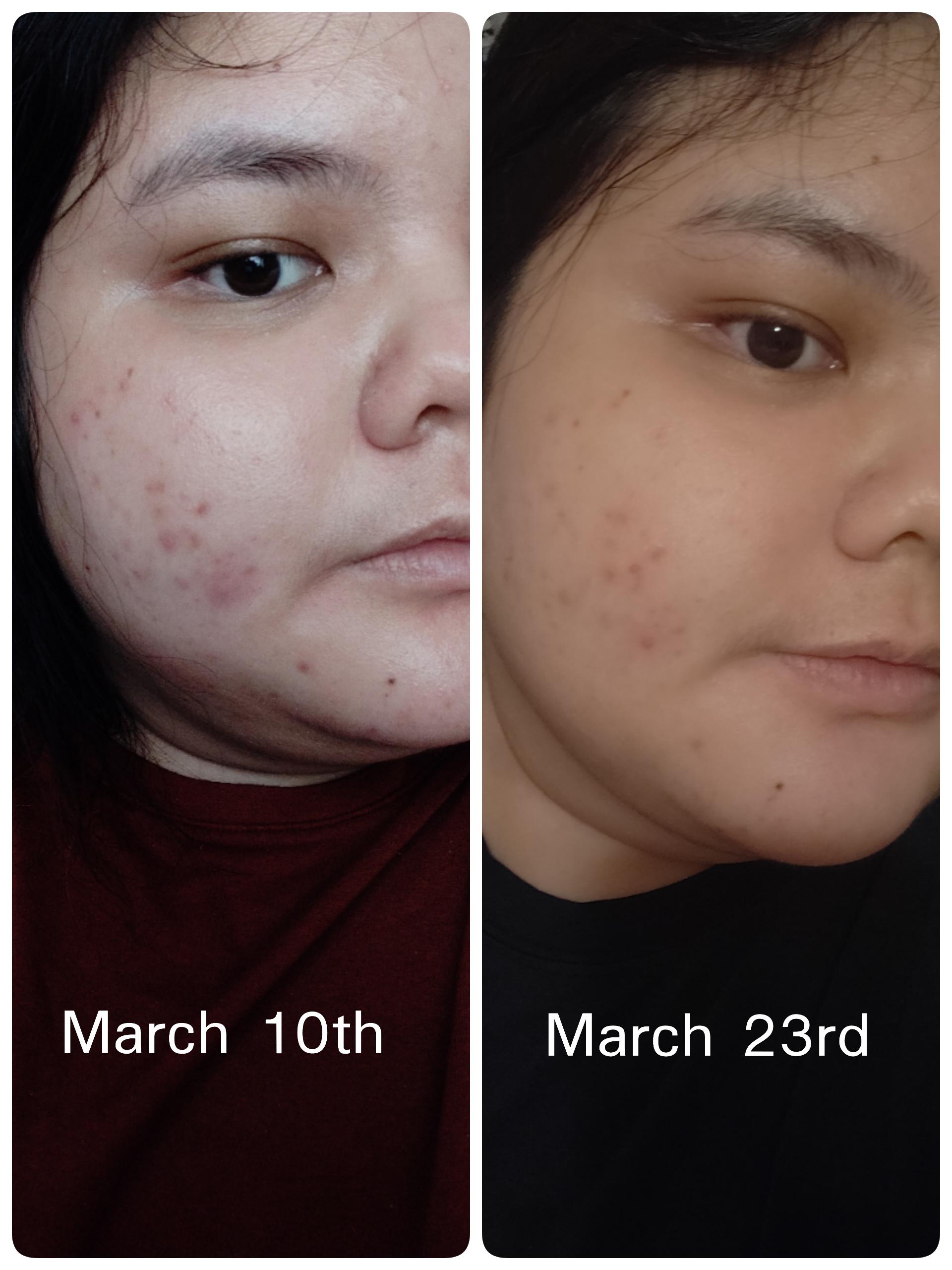 New Routine. Magic of salicylic acid, glycolic acid, and sunscreen