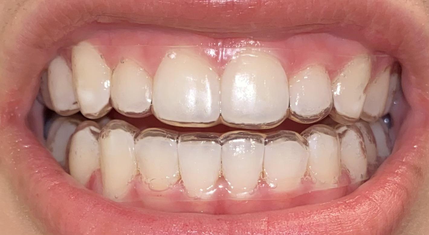 Finished Invisalign, do my retainers look like they fit ok? Didn’t read up on retainers so didn