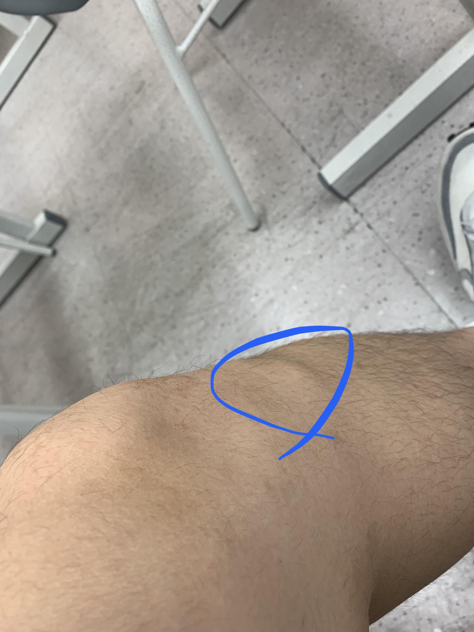 Hard lump (feels like bone) under kneecap. Def not on right leg. Only left, and no pain. I