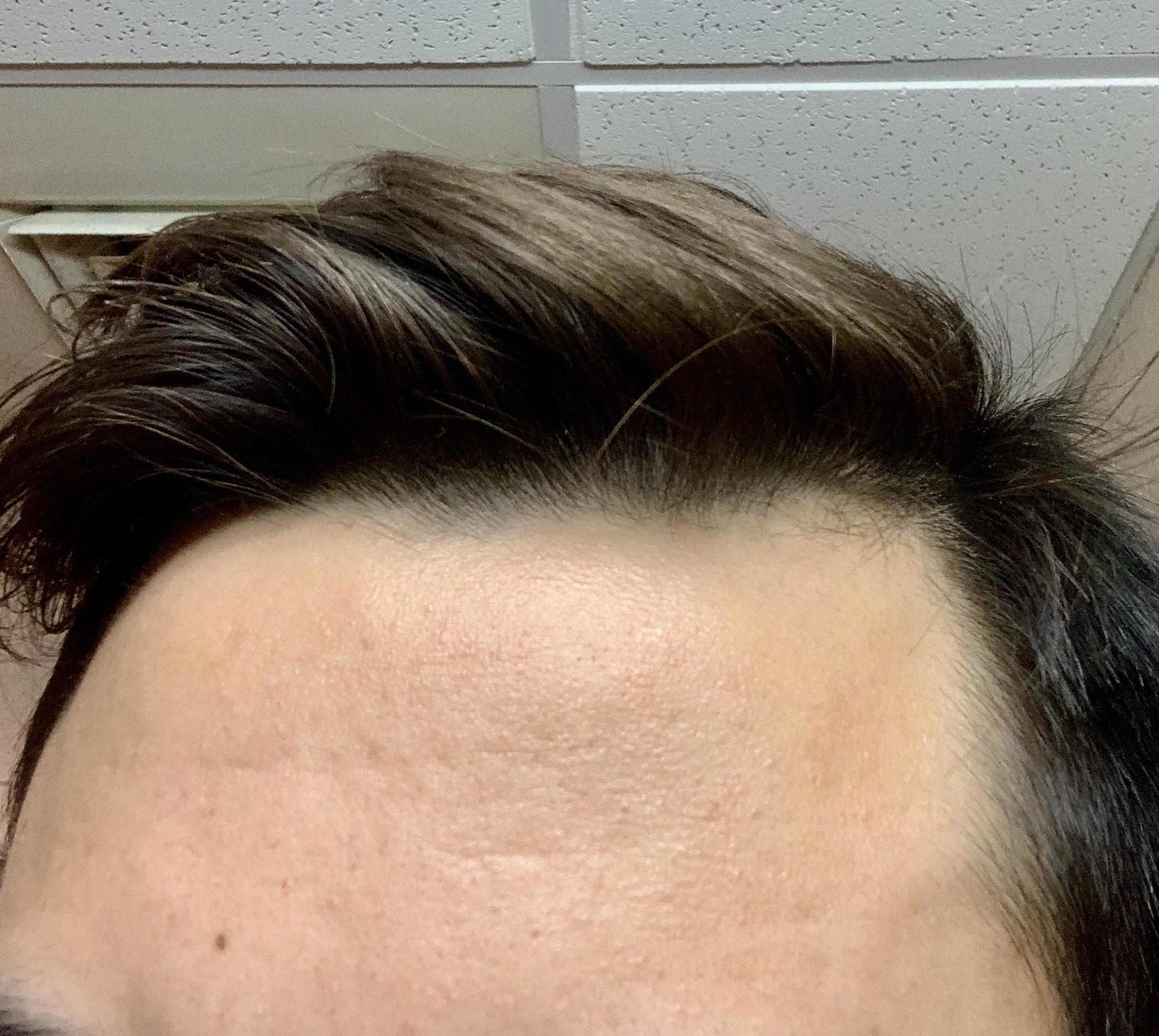 [skin concern] highly textured forehead and some creases/fine lines on