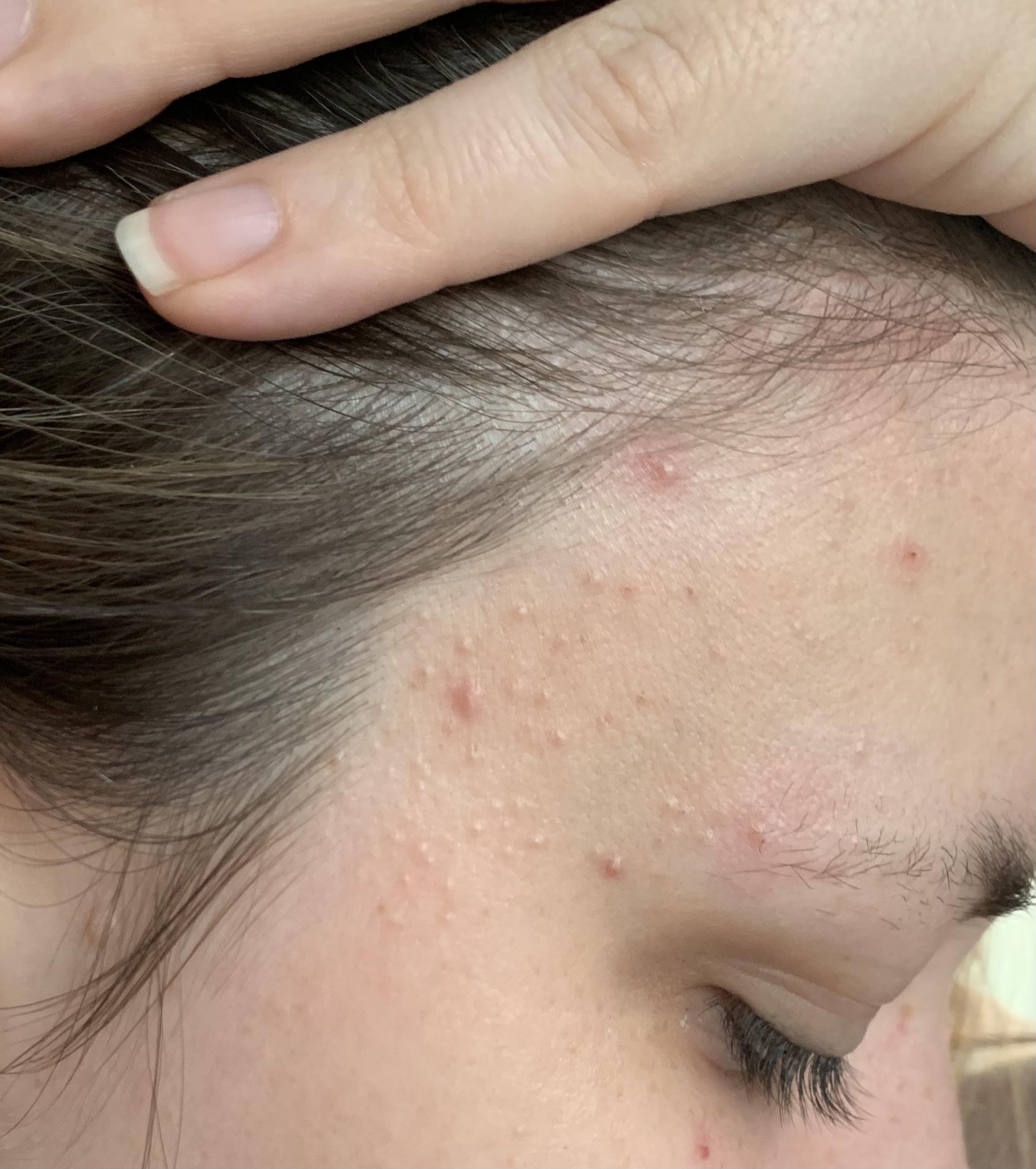 Fungal acne? Closed comodomes? Neither?! Help (more info in comments) r/Fungalacne