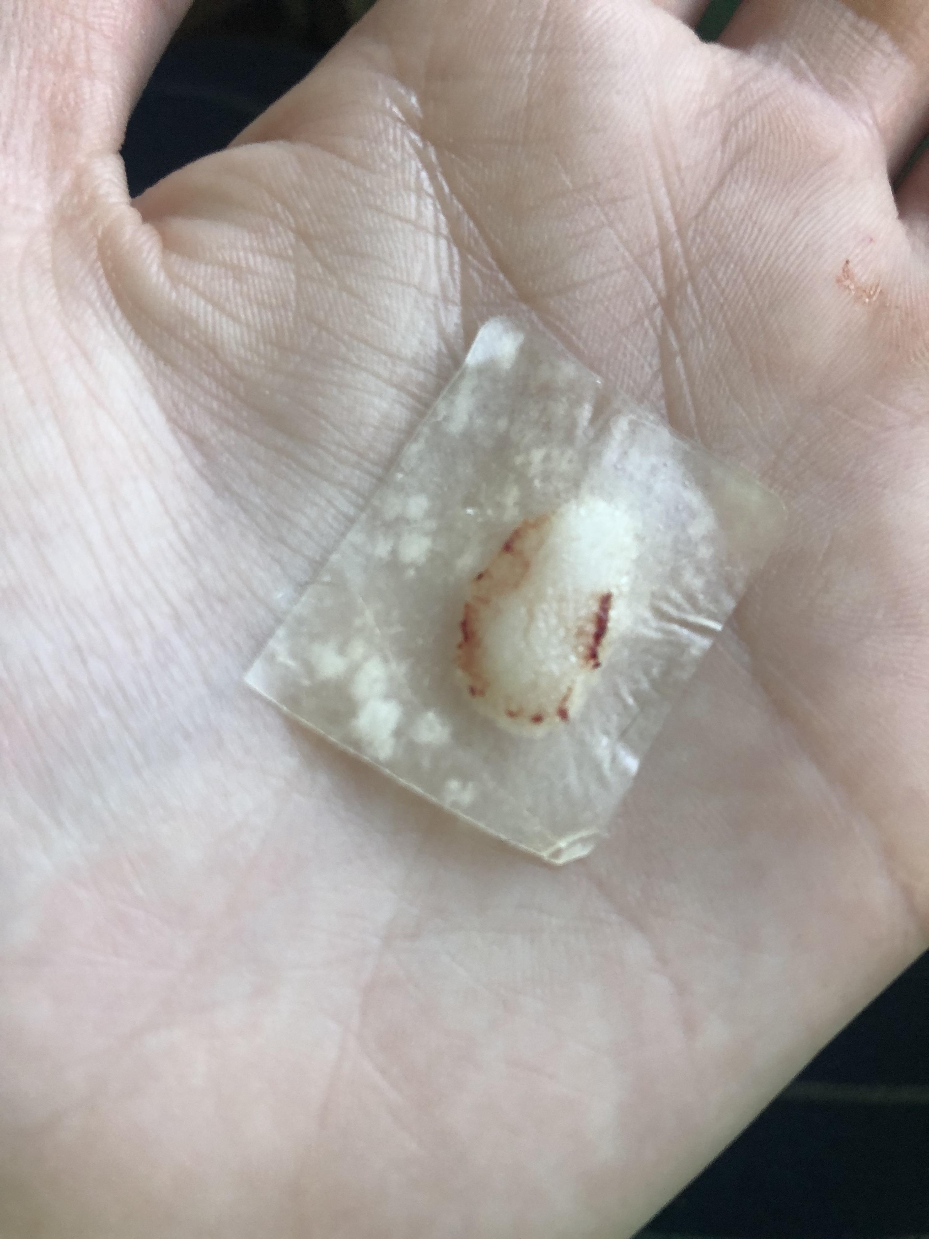 Much requested follow up hydrocolloid dressing for cystic acne 😅 popping