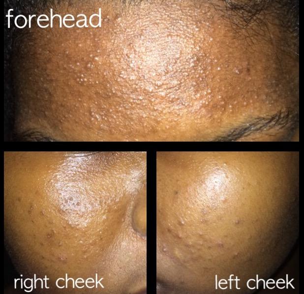 [Routine Help] Closed Comedones and Hyperpigmentation. No "Solid