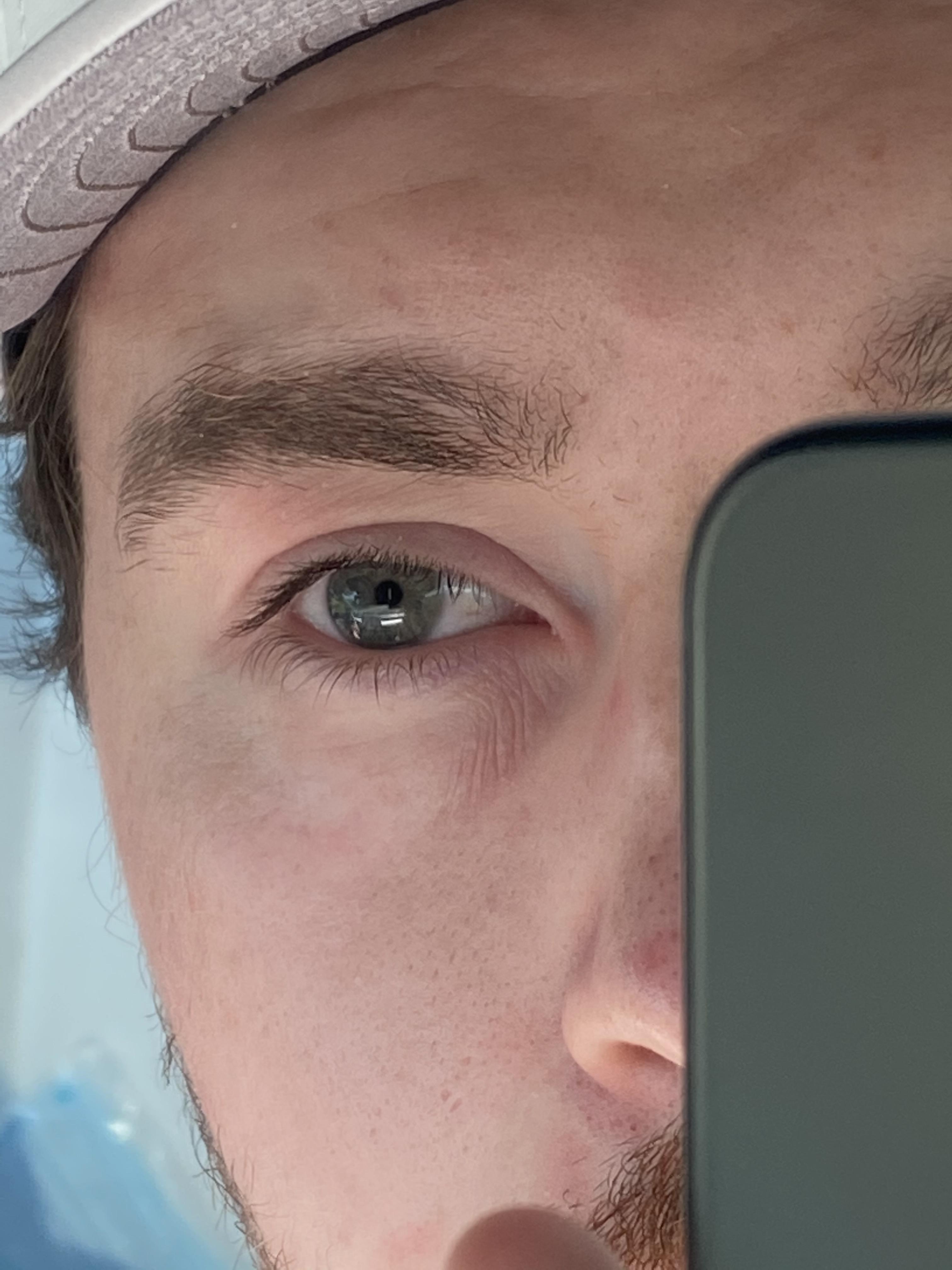 [Skin Concern] Dry under eyes gave me these eye wrinkles, how do I fix