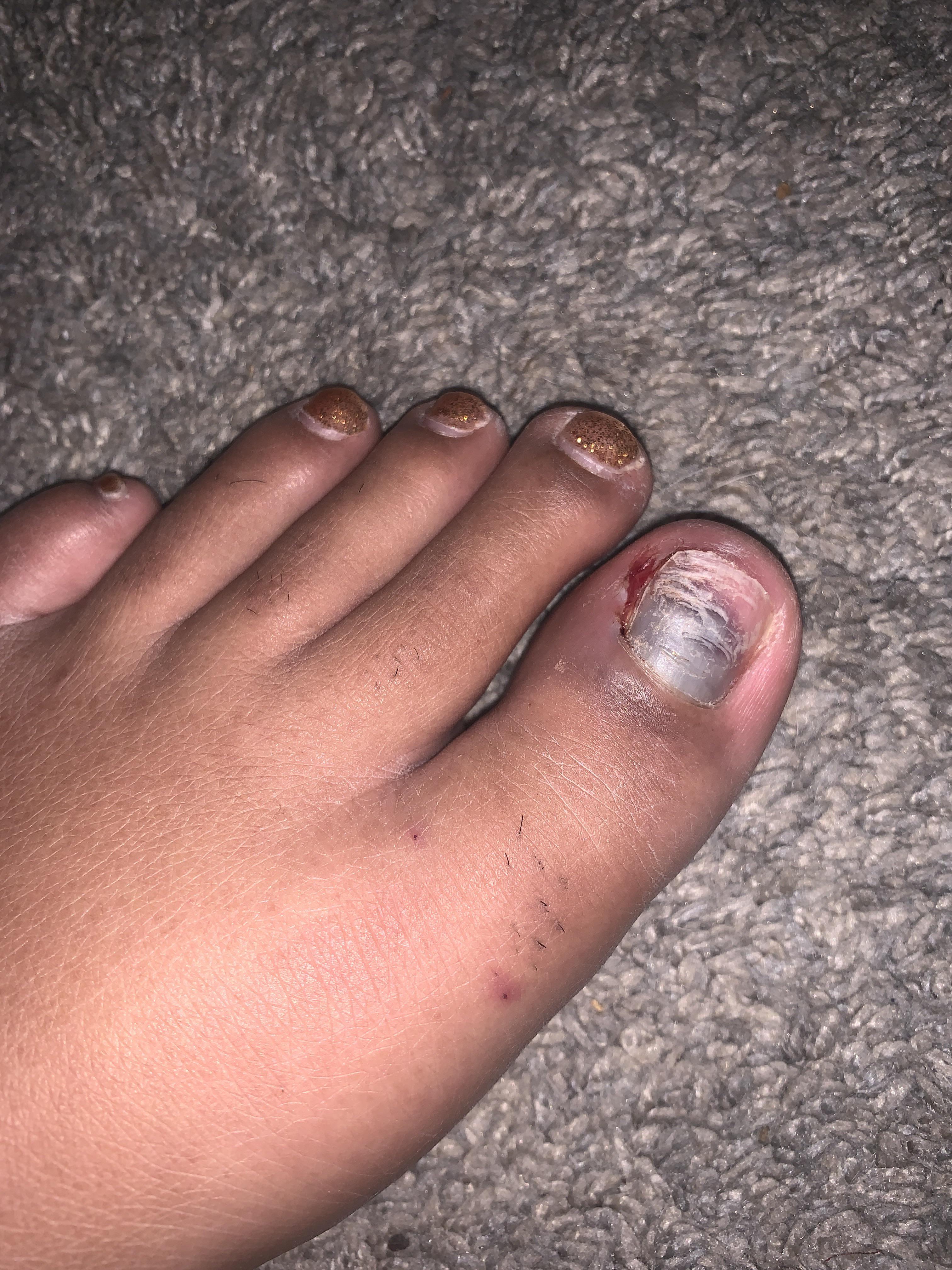 Partial nail avulsion yesterday—should I be worried that it looks like