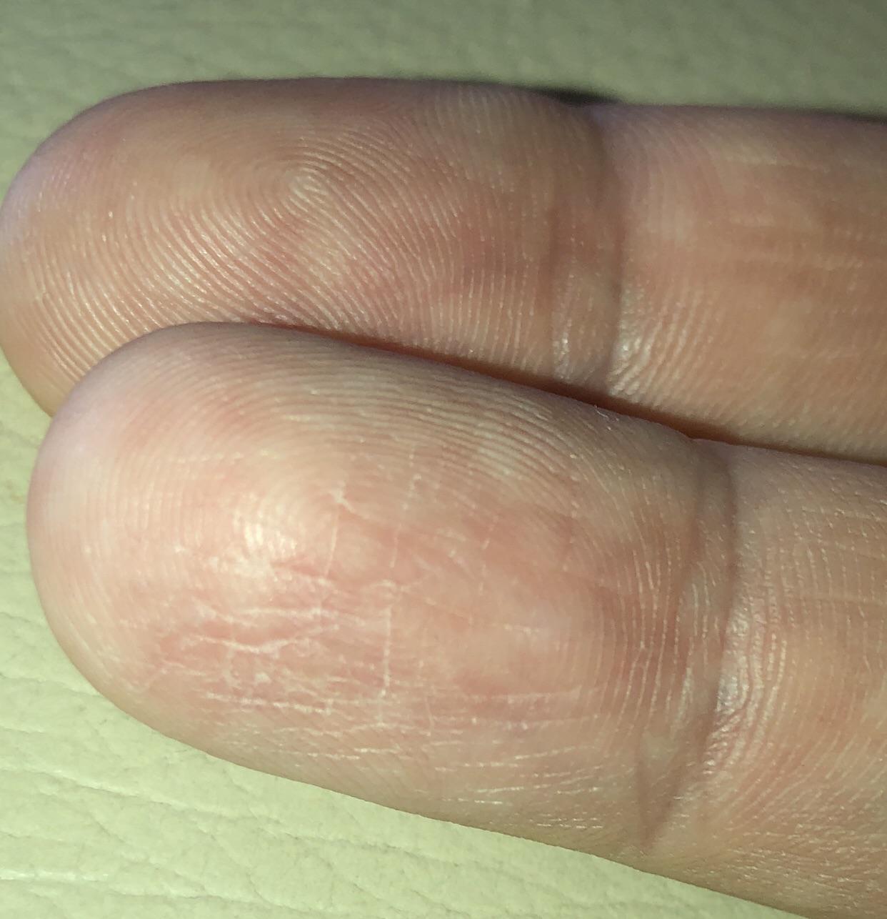 My finger tips are cracked and pruned and feel numb. Could anyone