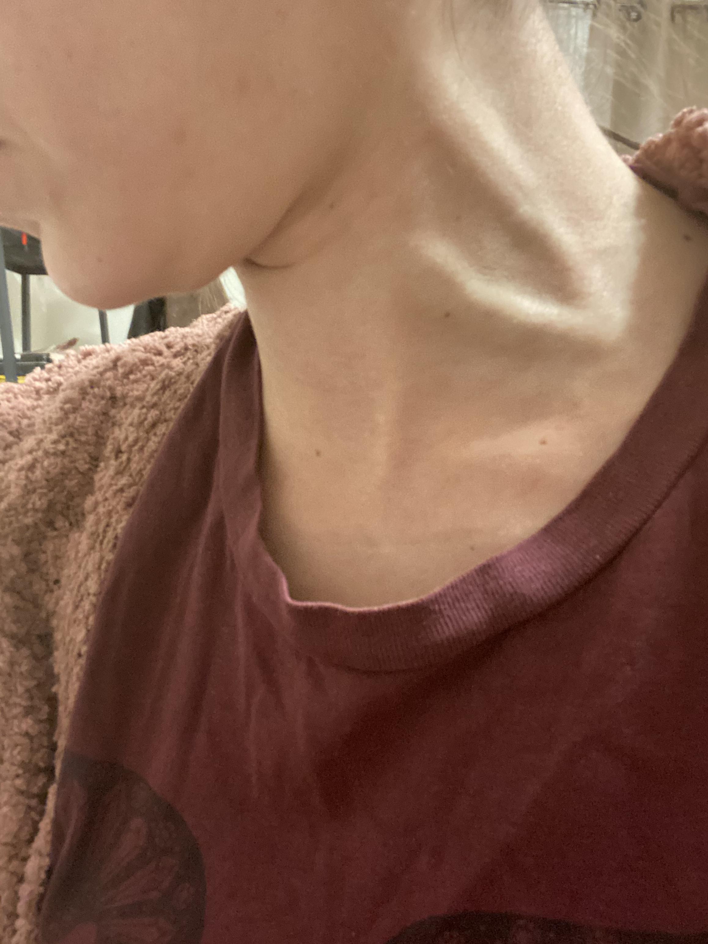 Over the past couple years I’ve developed prominent veins all over. My