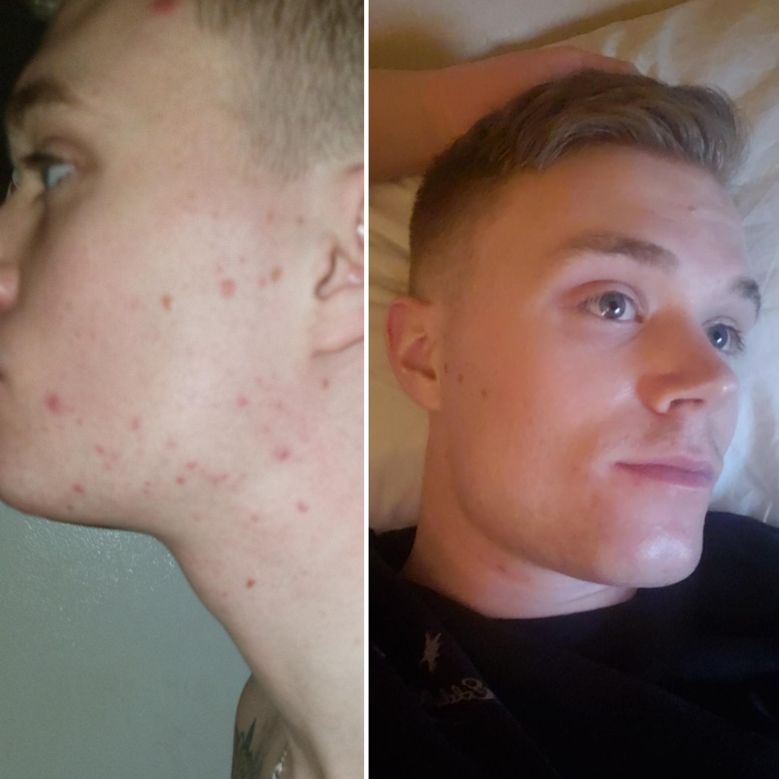 Albums 99+ Pictures B Flat Cream Before And After Pictures Updated