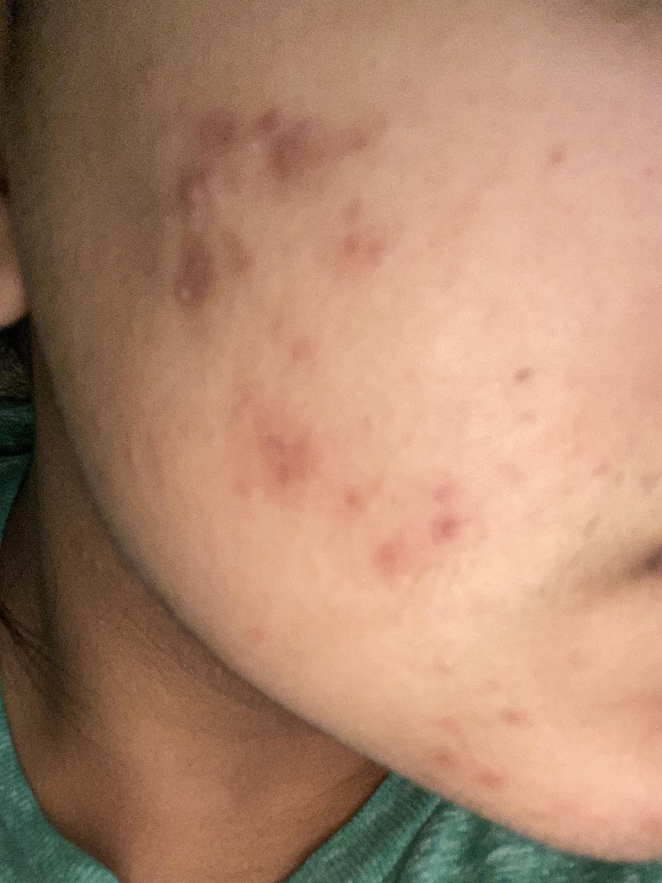 I have glycolic acid, hyaluronic acid, niacinamide acid, lactic acid