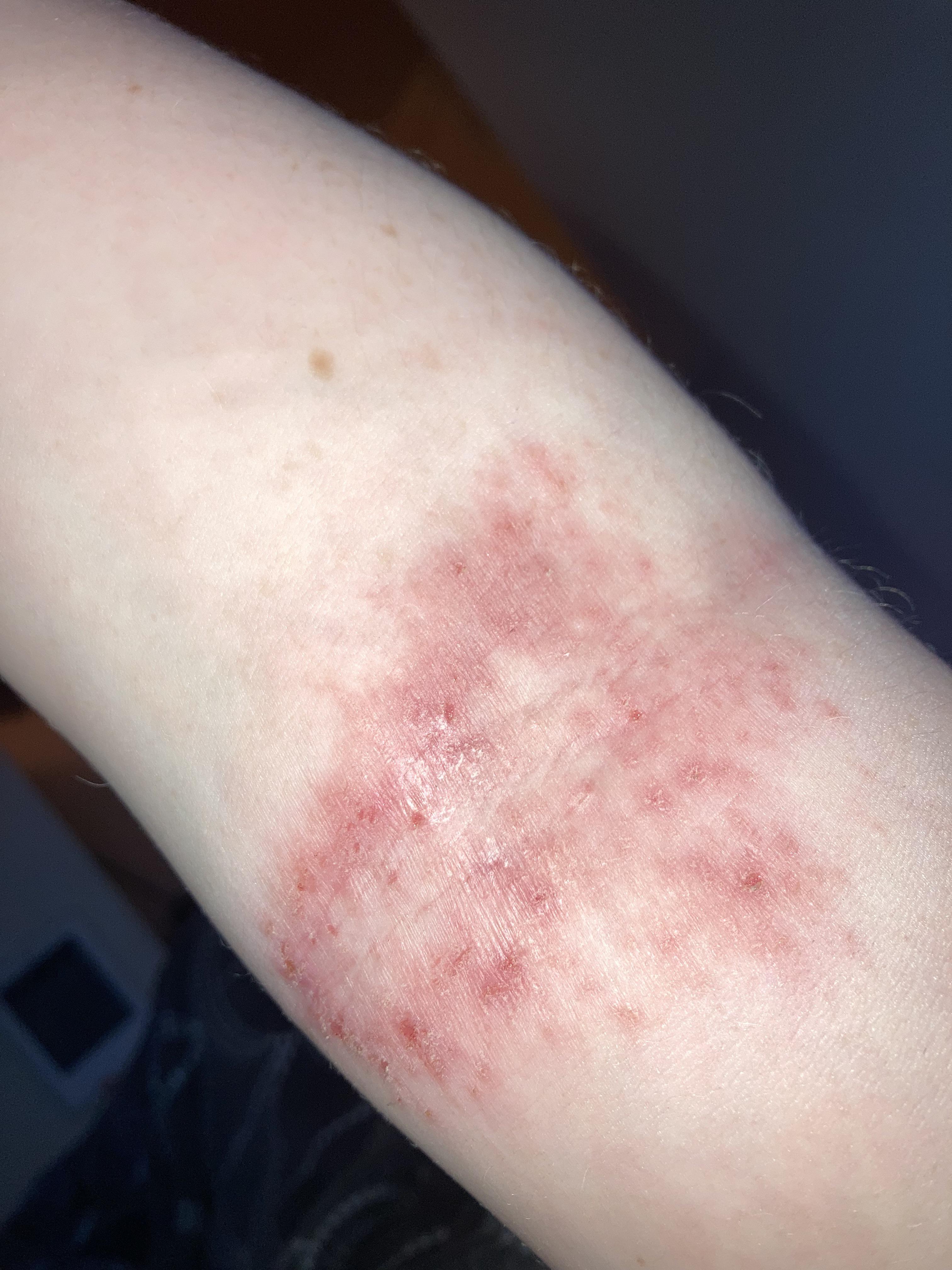 Eczema on inner elbow r/eczema
