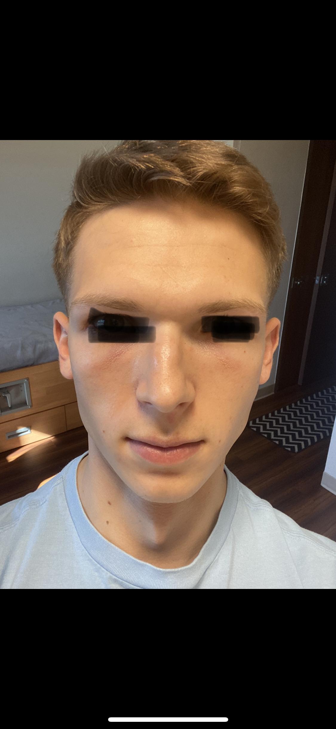 Redpurple lines under my eyes, what’s the best option to fix it? r