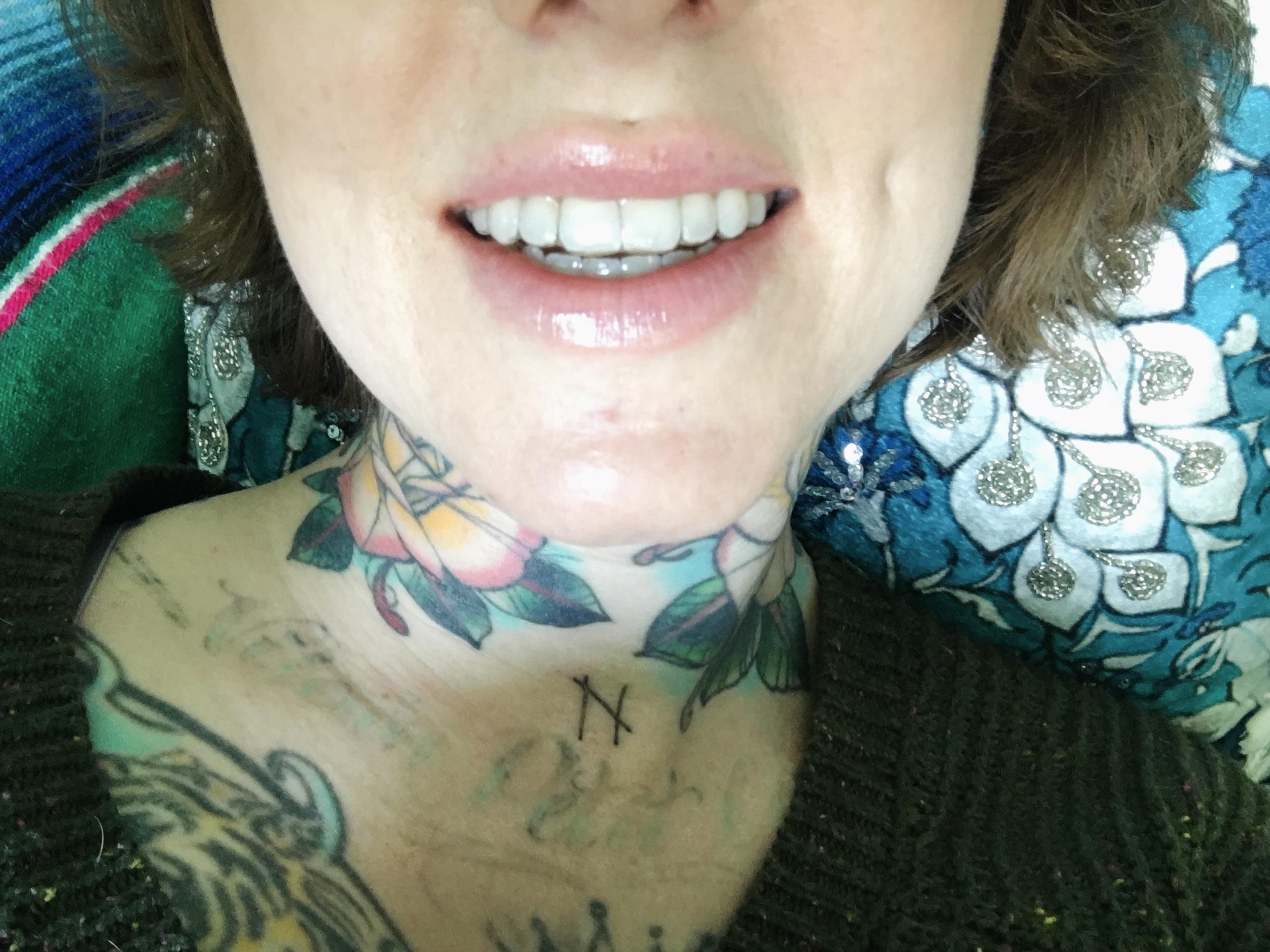 Has anyone tried activated charcoal with ceramic clear band braces