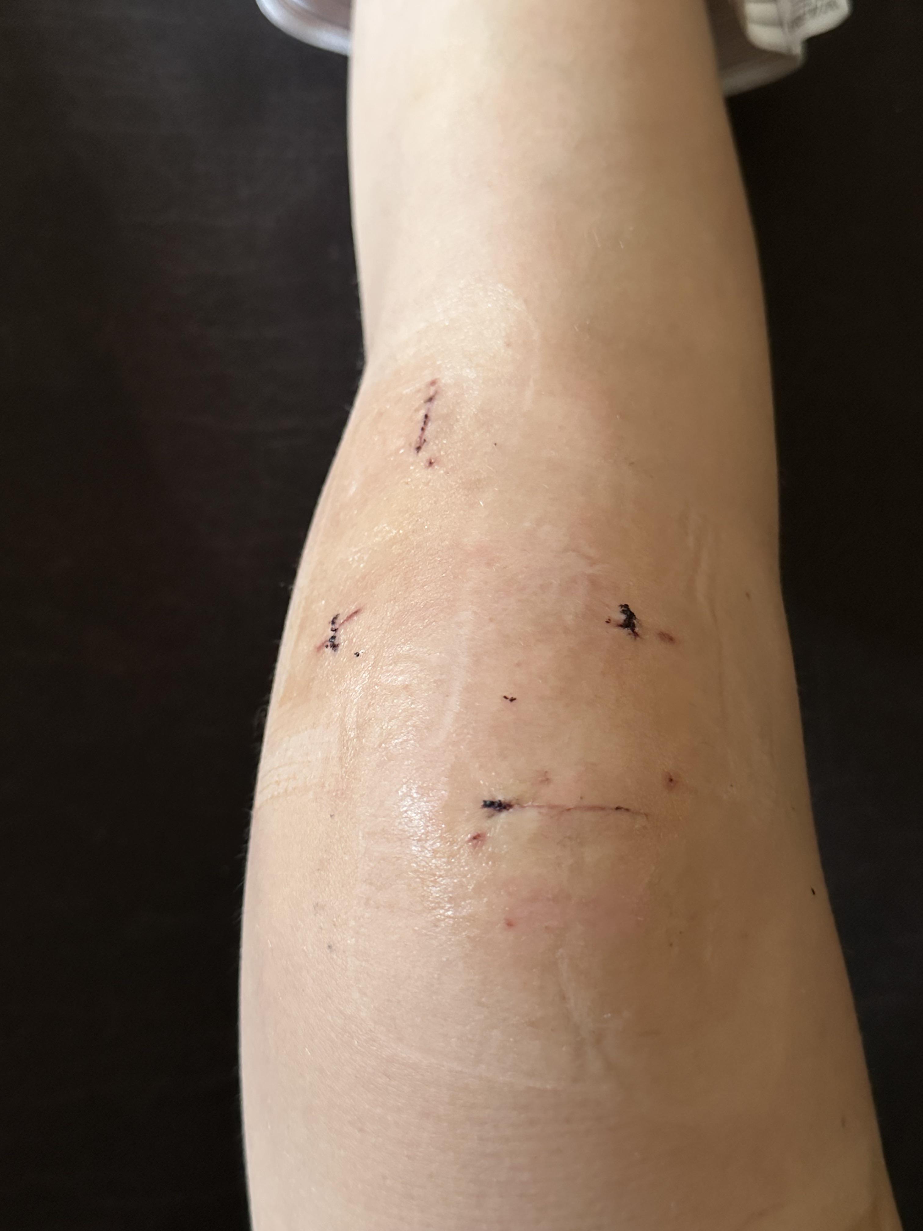 what are the respective scars for? quad graft r/ACL