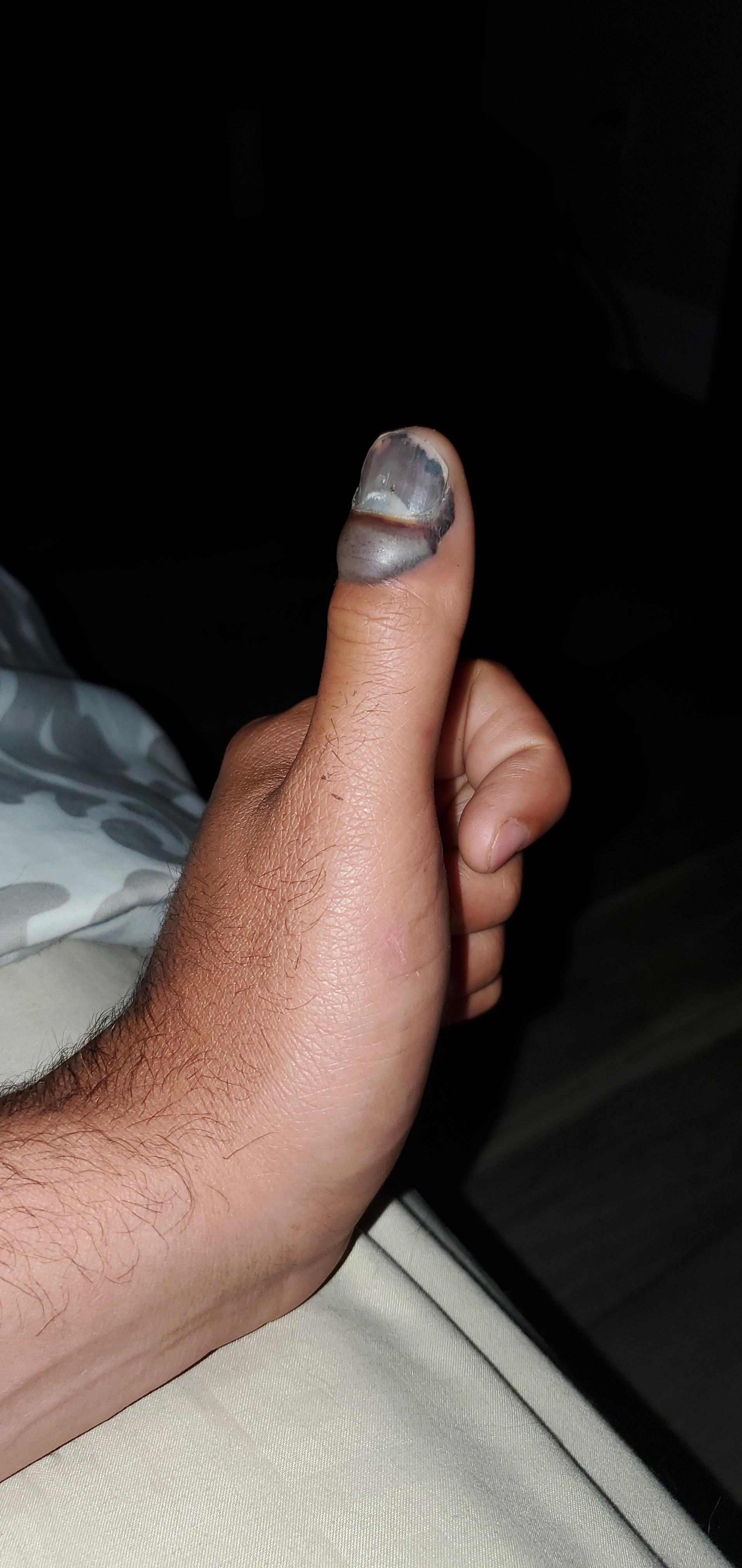 Smashed my finger using an open ended box wrench as a hammer. Not using