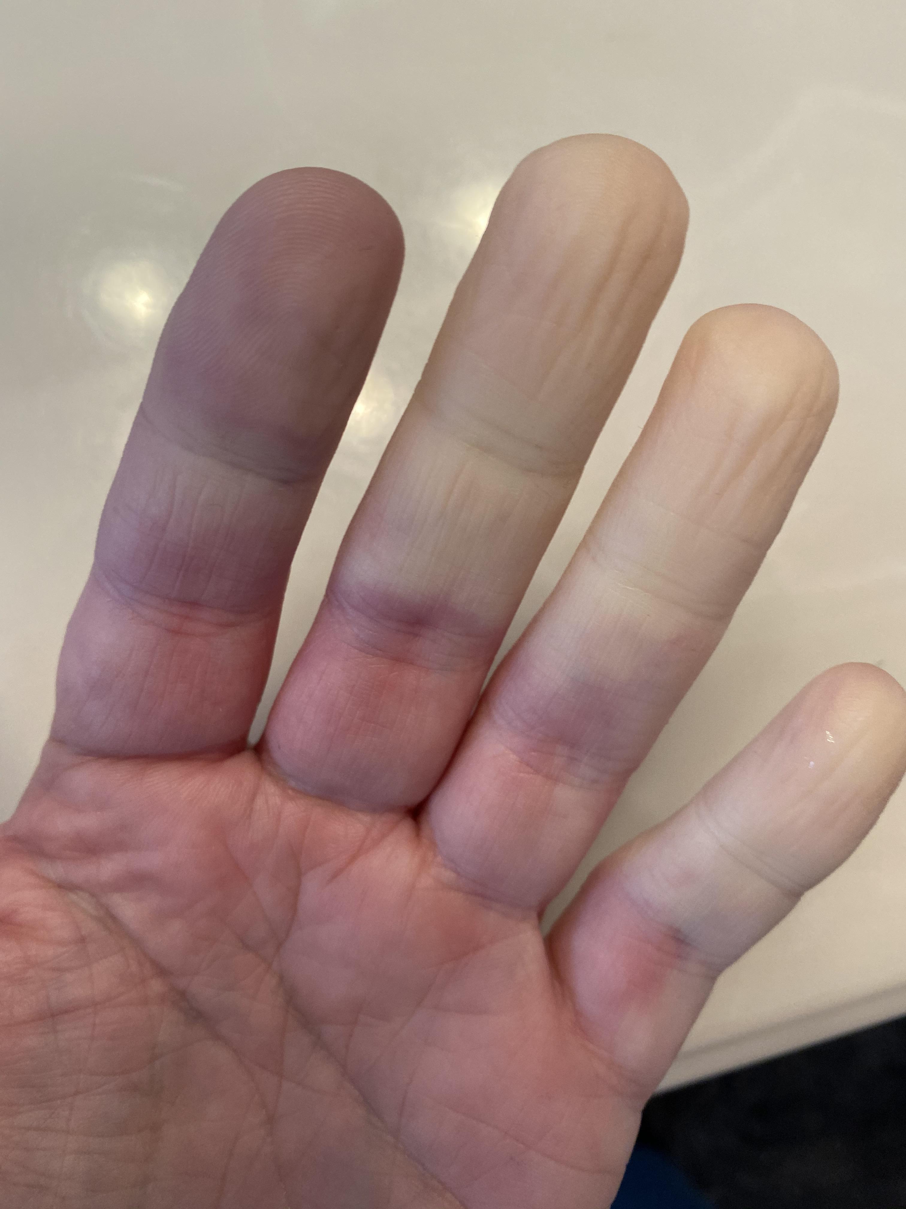 This is what my Raynaud’s looks like every day... In the morning it’s