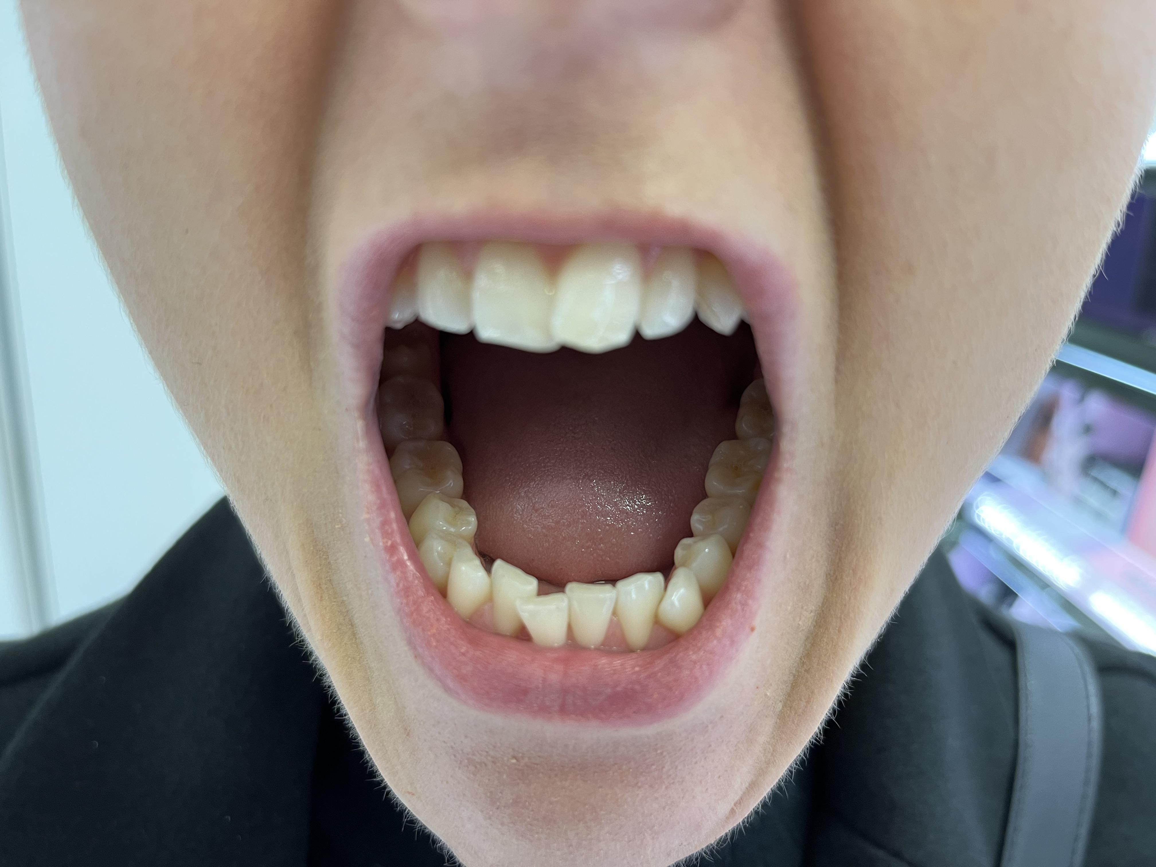 Invisalign vs Damon clear braces r/askdentists