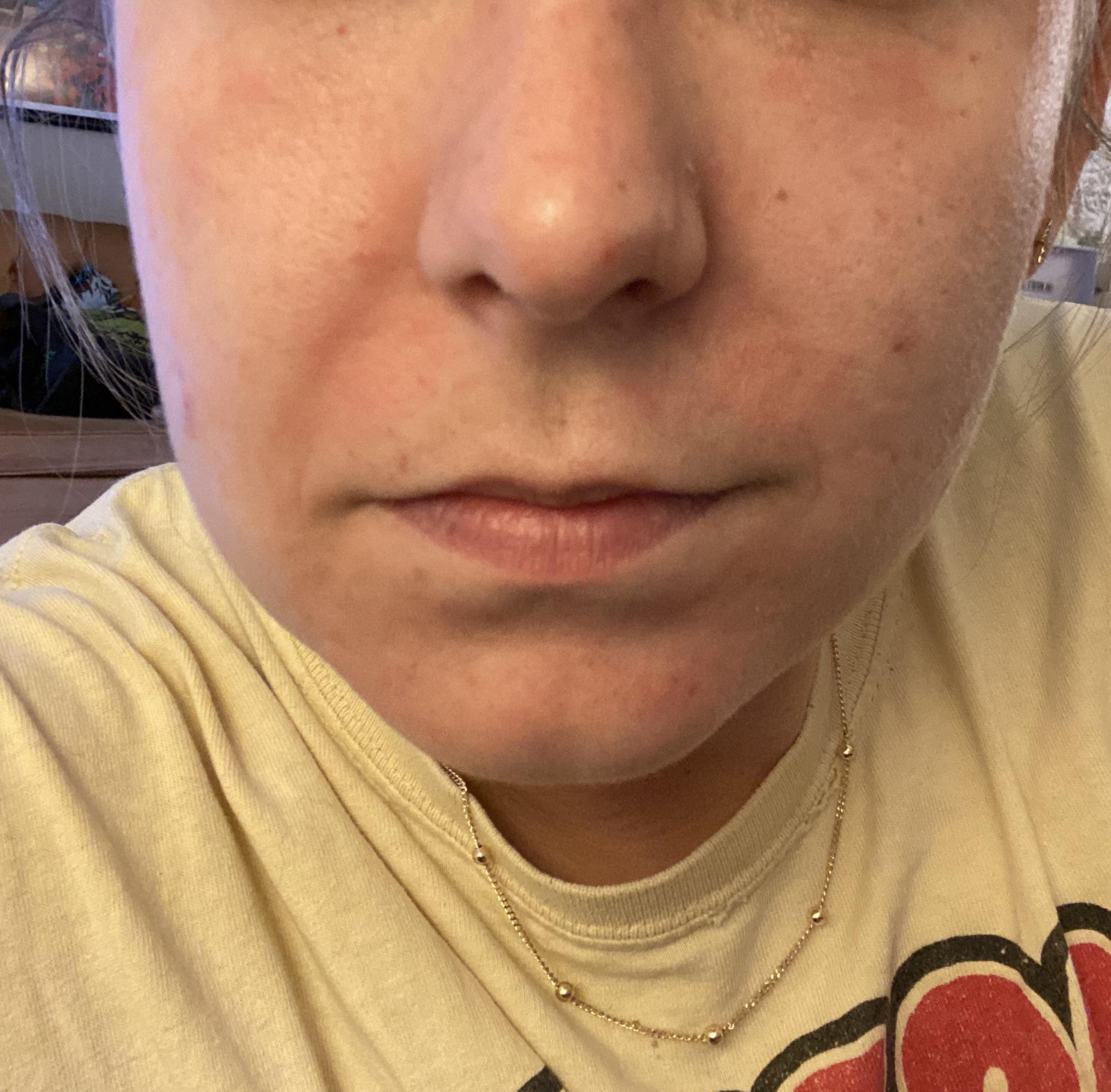 [Skin concerns] Diagnosed with perioral dermatitis this week. Derm