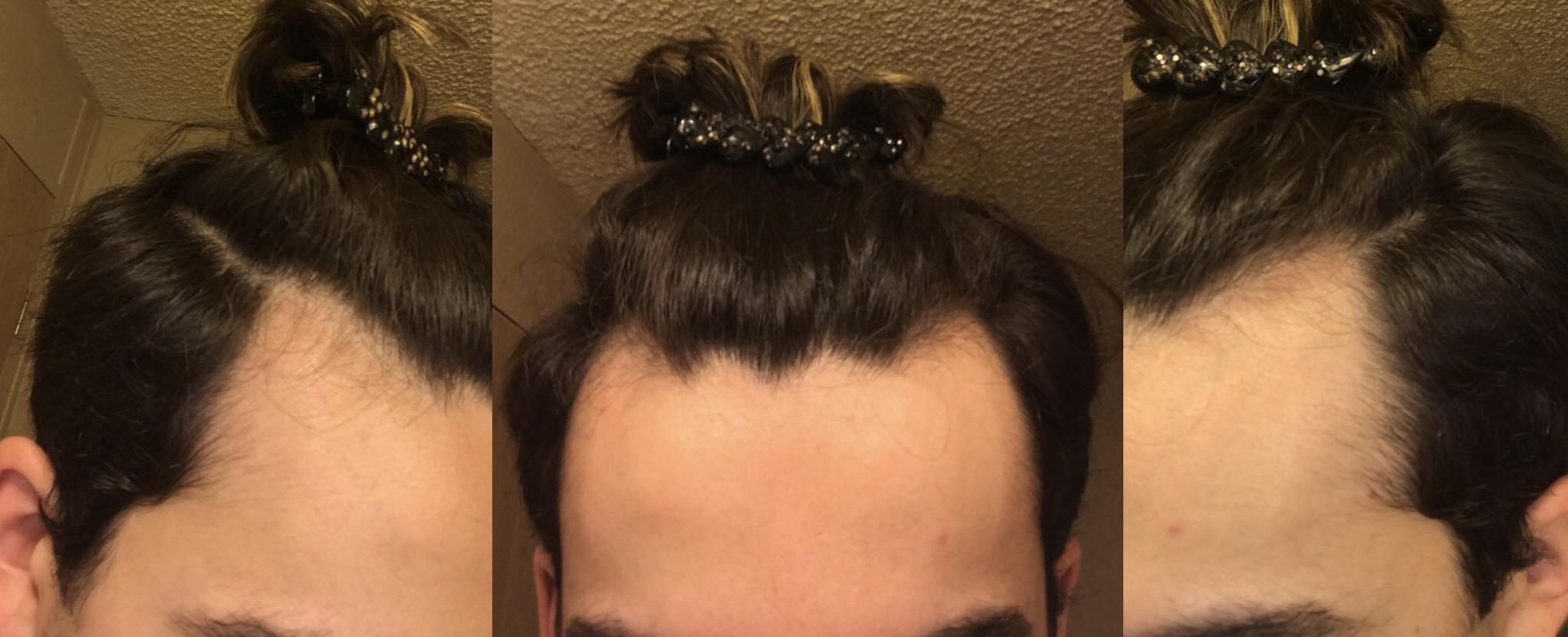 Am i losing hair? Is my hair thinning ? r/Hairloss