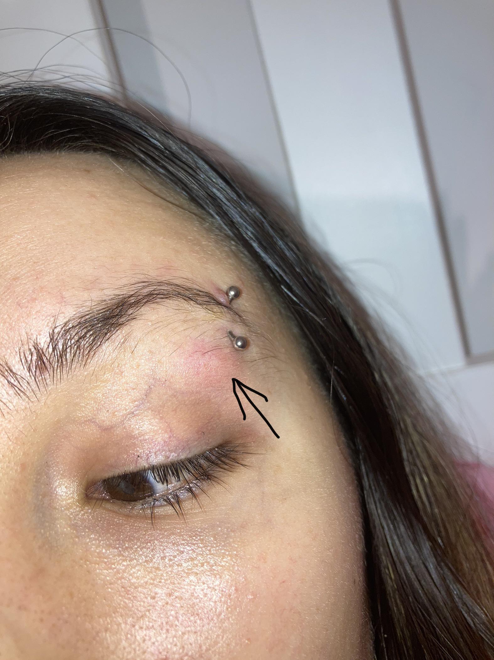 I got this weird bump underneath my eyebrow piercing and I don’t know