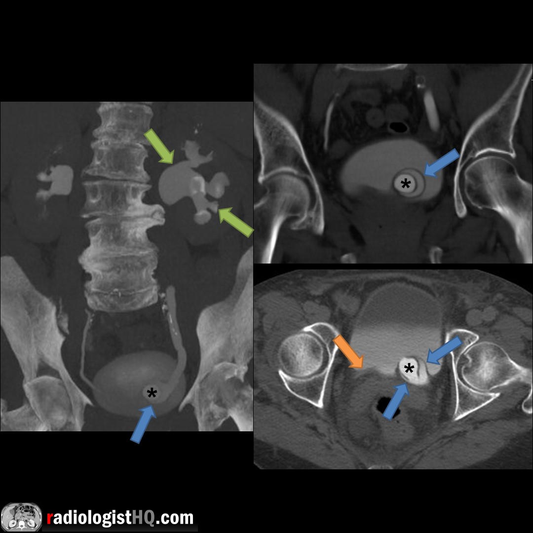 Ureterocele with obstructing stone on CT urogram Radiology