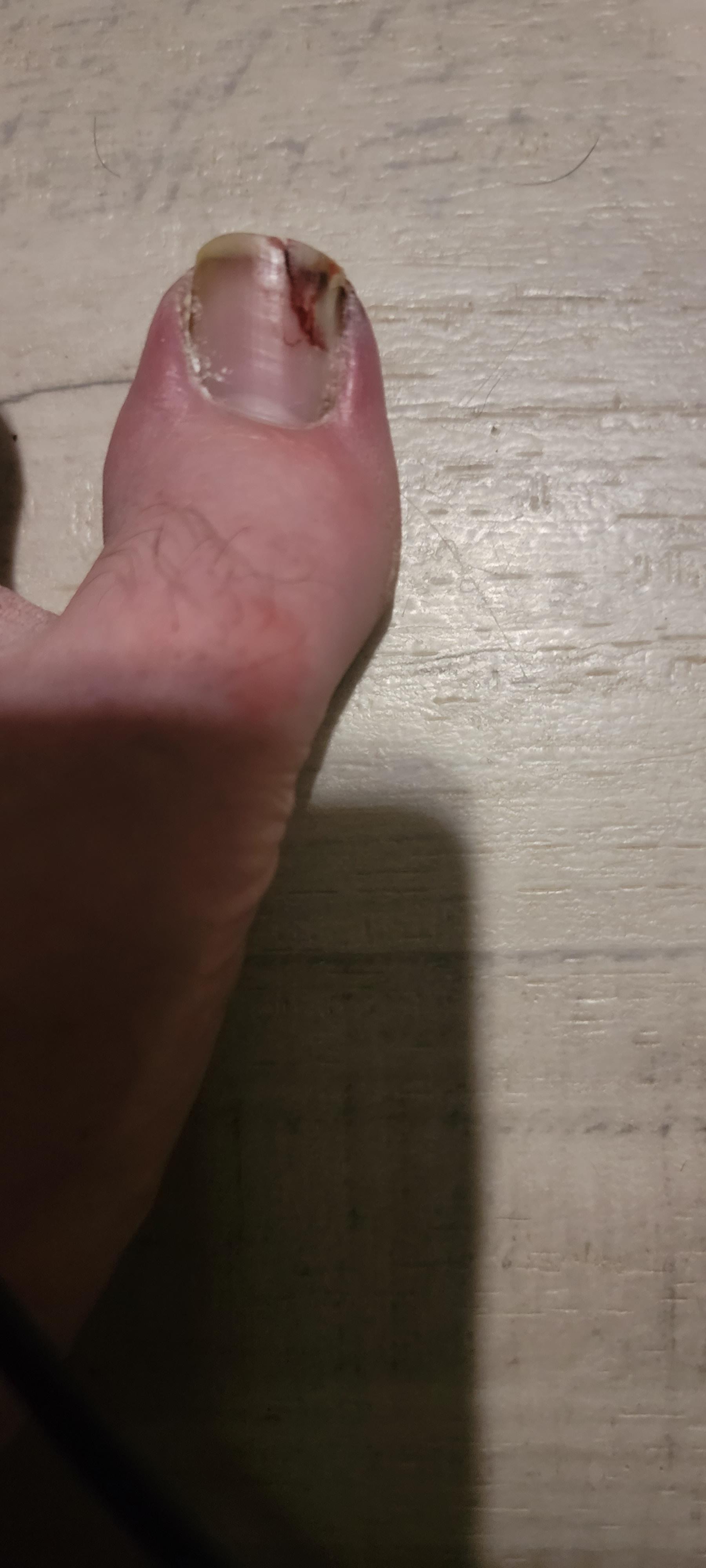 Stubbed Toe Toenail is split r/medical_advice