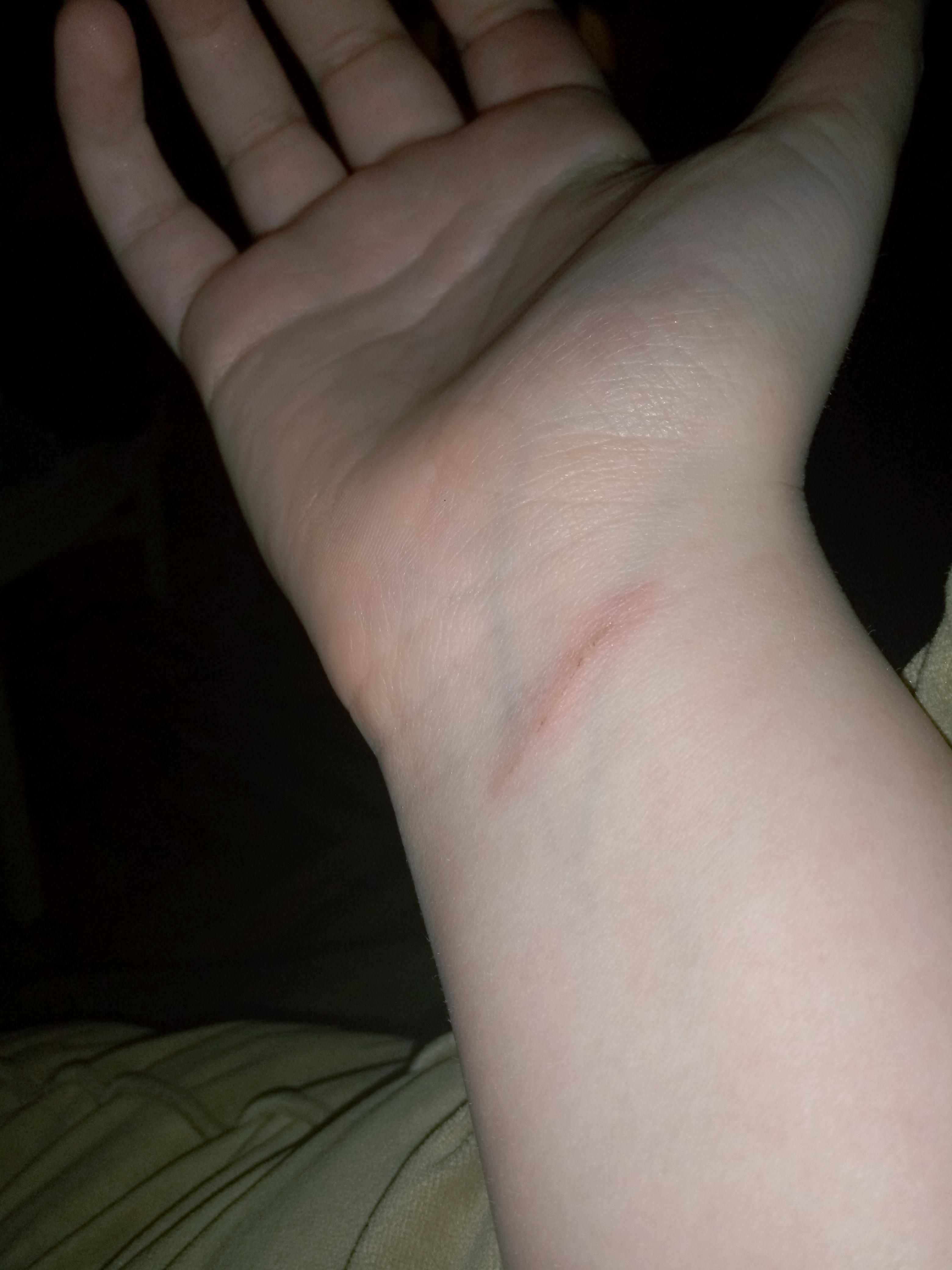 so I got a cut on my wrist from the broken handle of the laundry basket