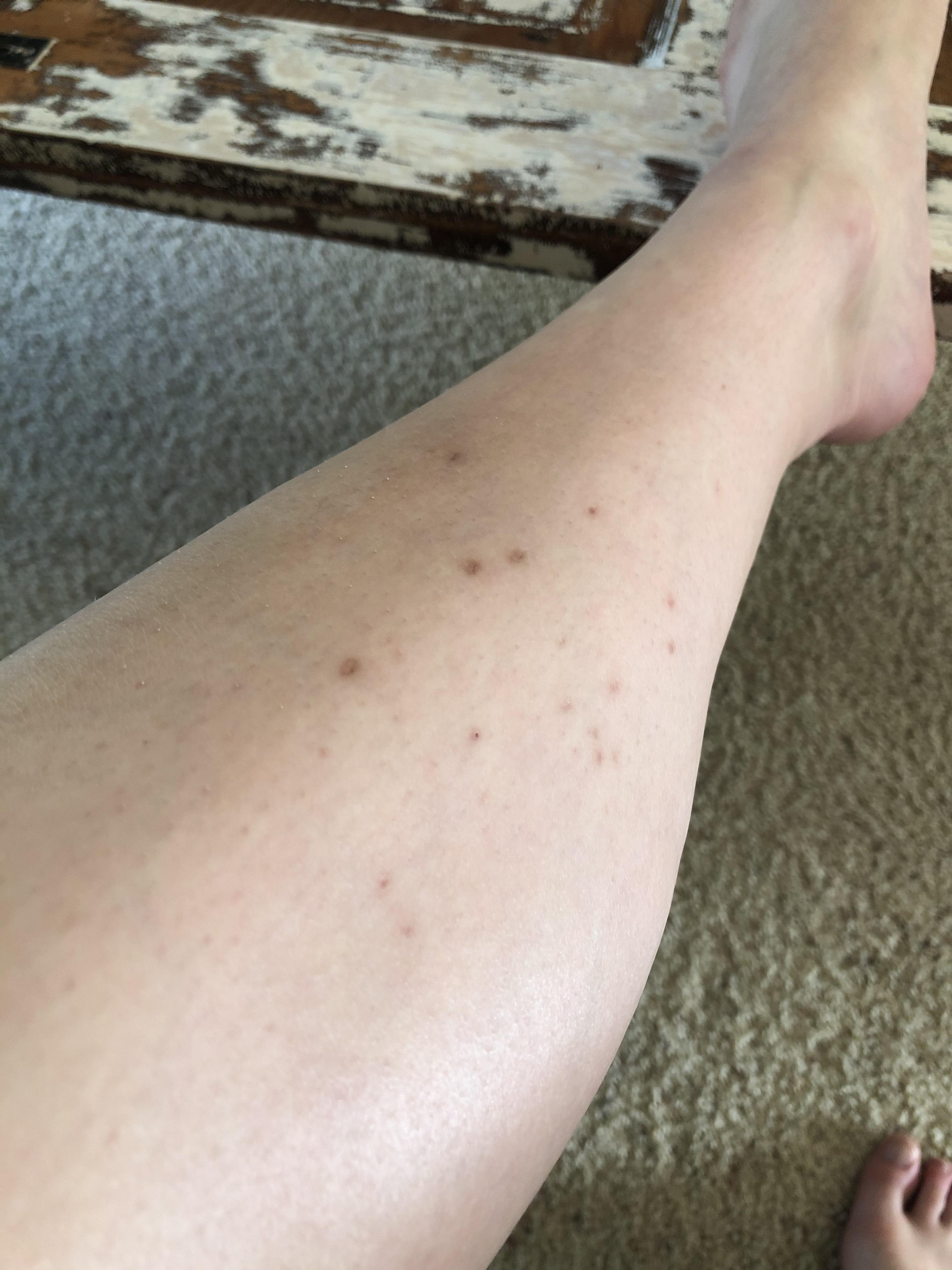 [Hair Removal] Suggestions for getting rid of hyperpigmentation on legs