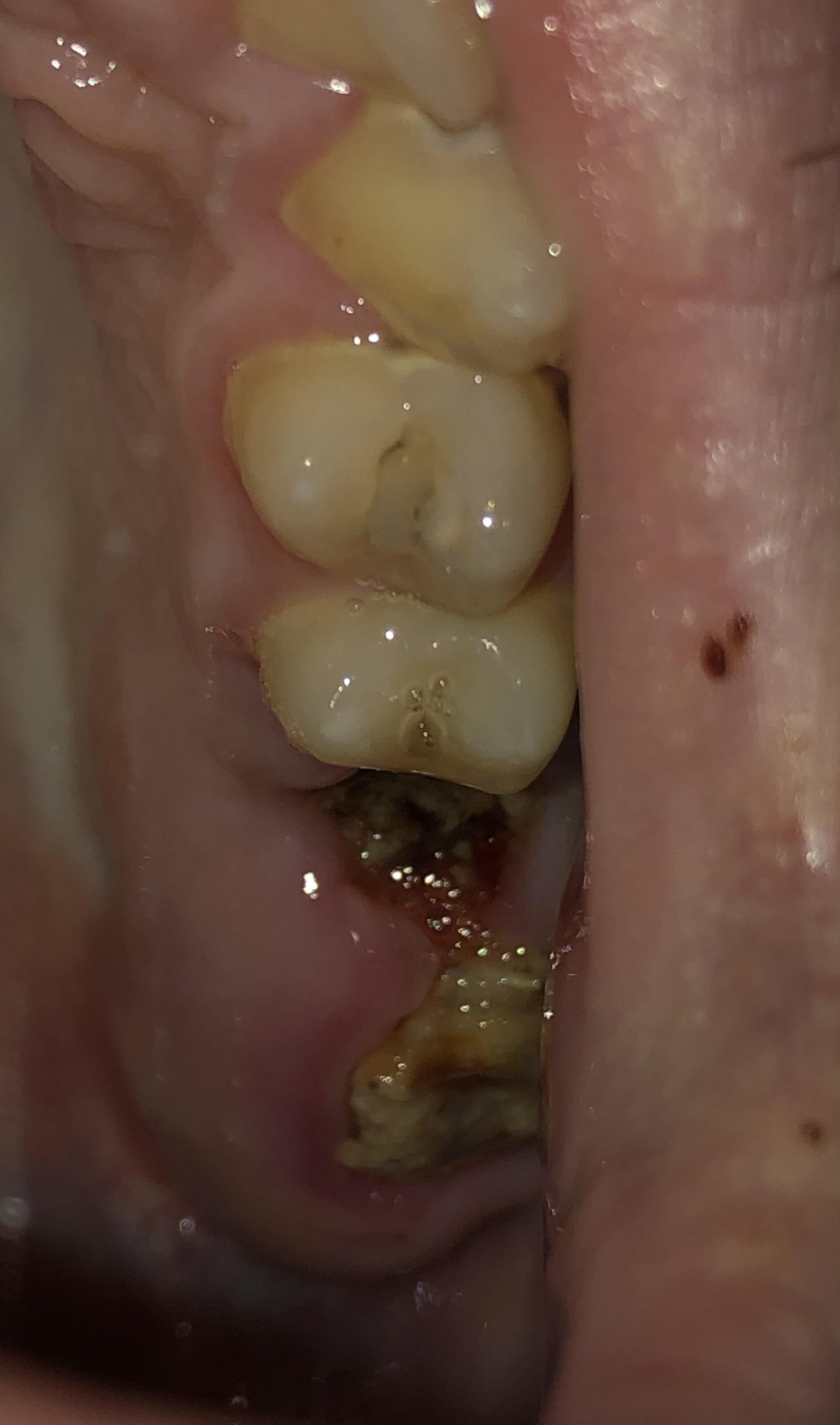 4 days after extraction top left side molar. Does this look okay? I’ve