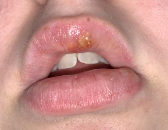 Cold sore or shingles? Especially the upper lip one. An