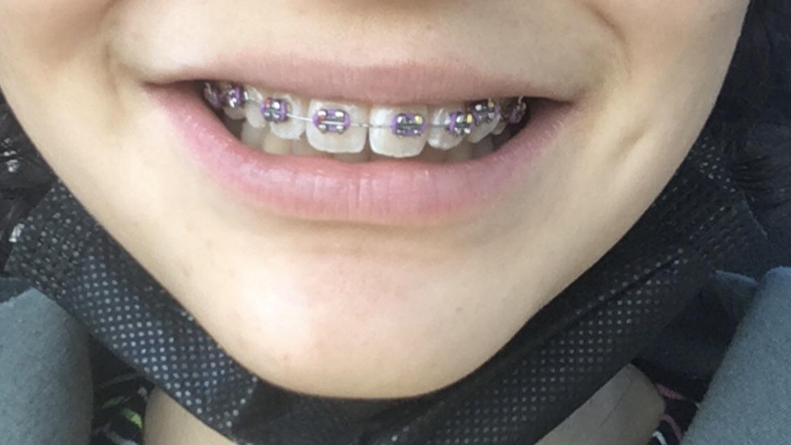 Started my braces journey ) braces