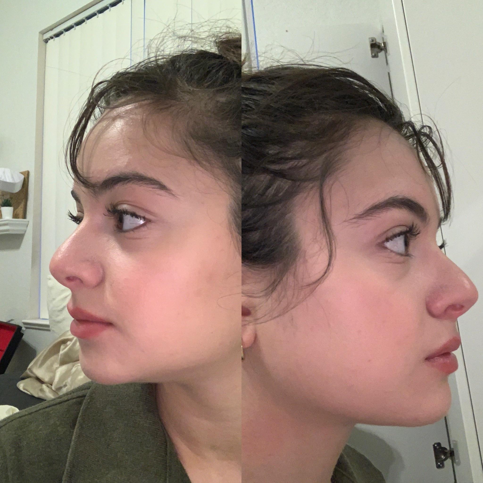 if i get a nose job, 1. will it make me look a little better and 2. can